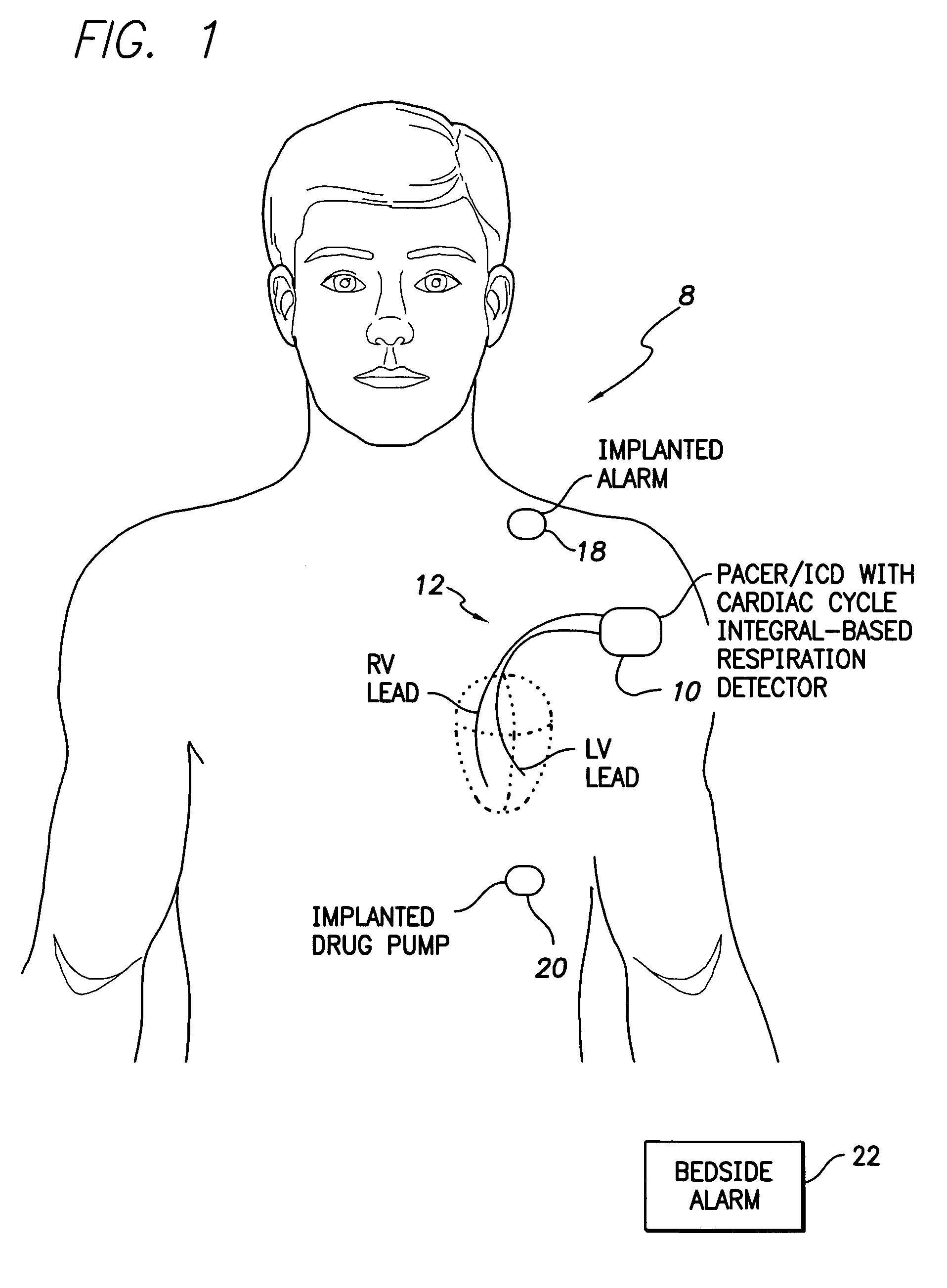 System and method for detection of respiration patterns via integration of intracardiac electrogram signals