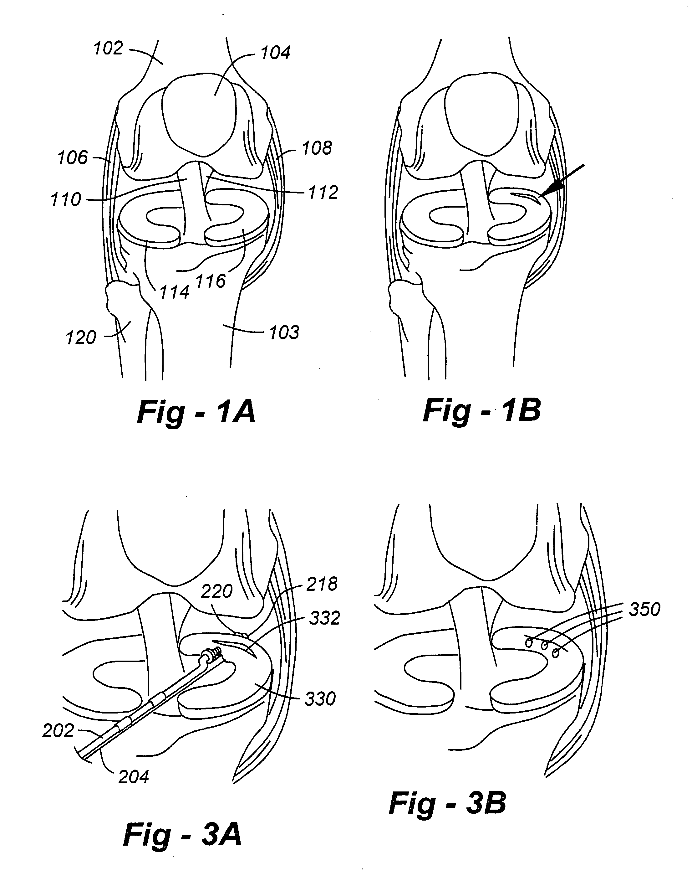 Compression tissue repair apparatus and methods