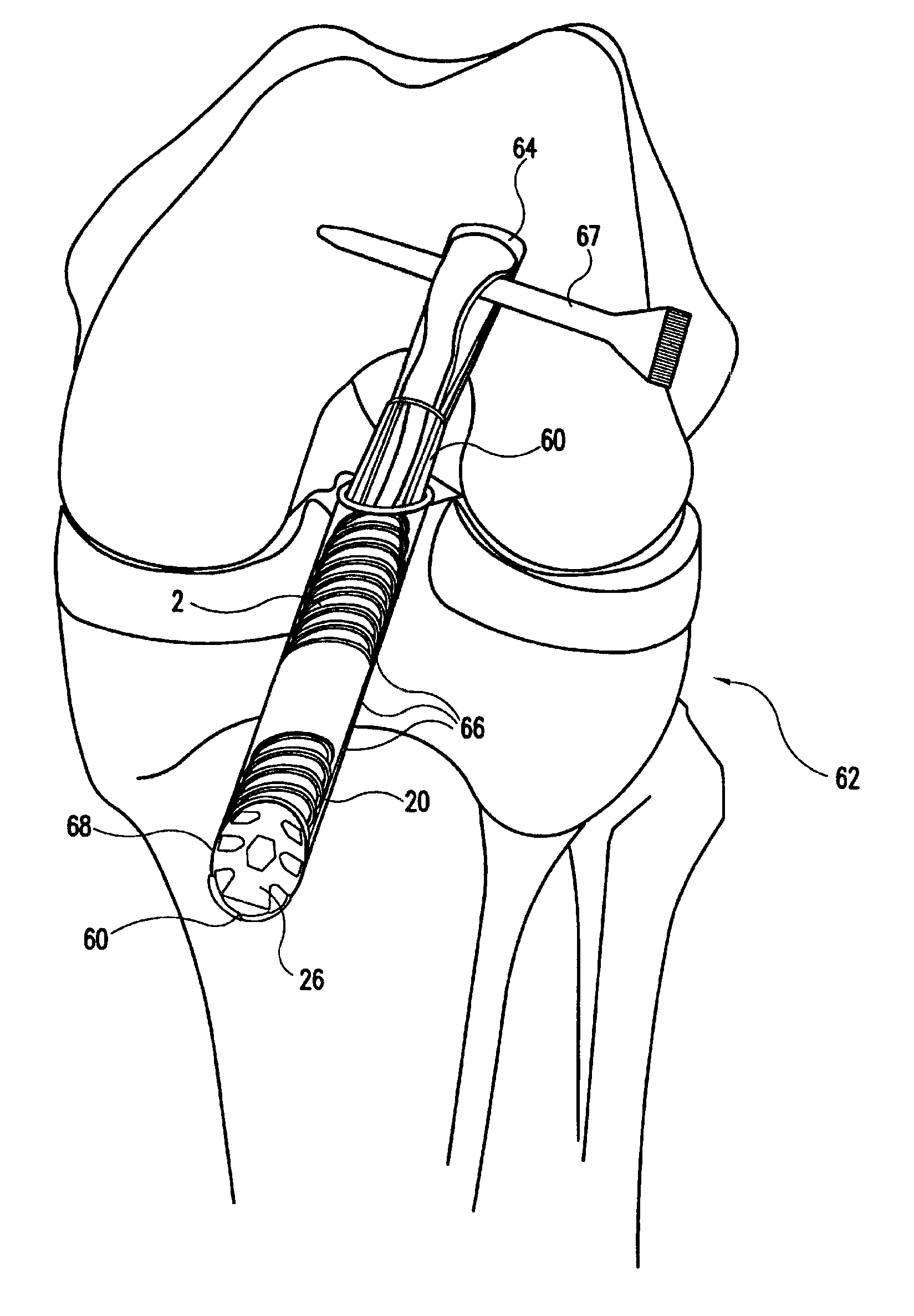 Bicortical tibial fixation of ACL grafts