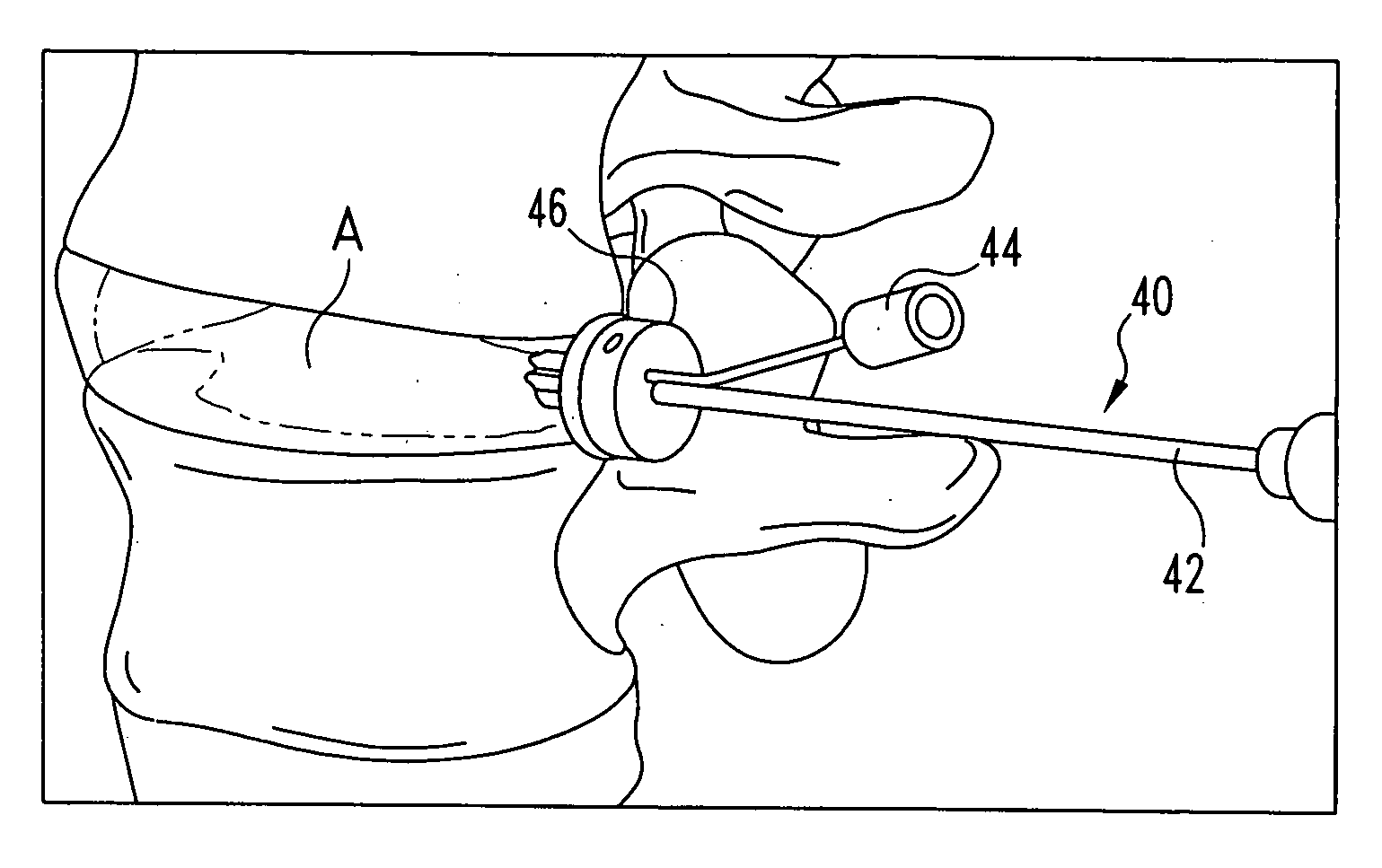 Methods for injecting a curable biomaterial into an intervertebral space