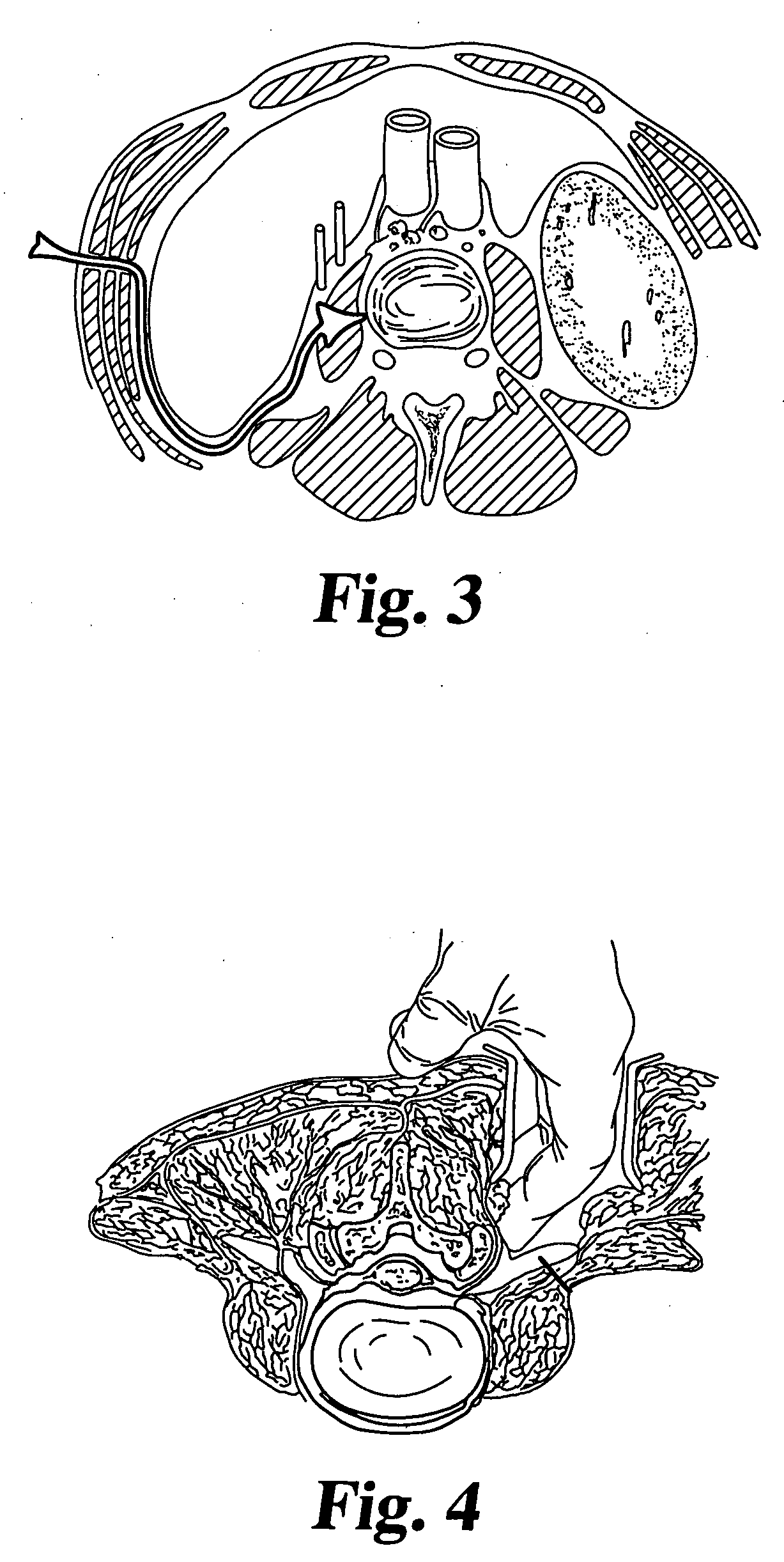 Methods for injecting a curable biomaterial into an intervertebral space