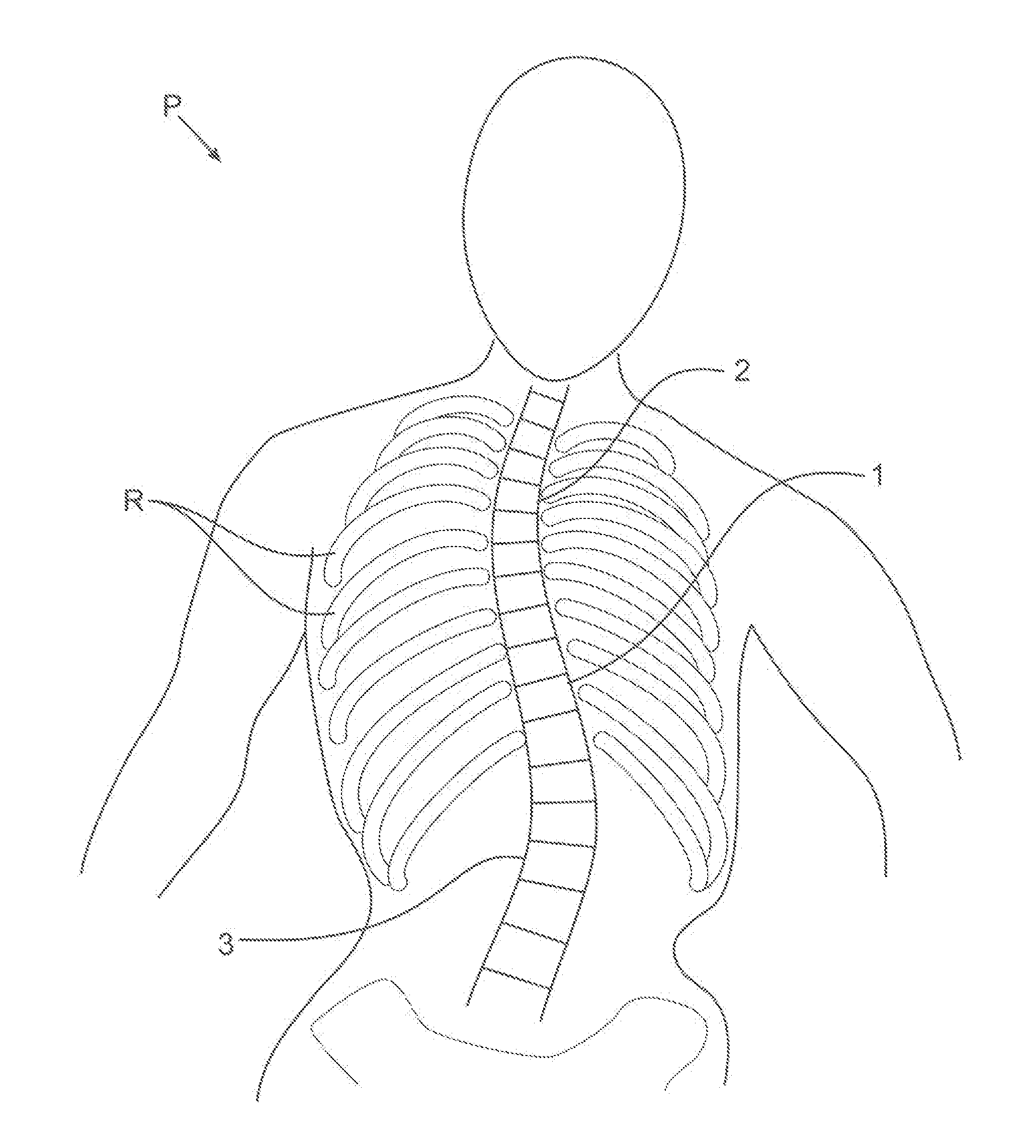 Percutaneous method for aligning a spine using deployable bone anchors