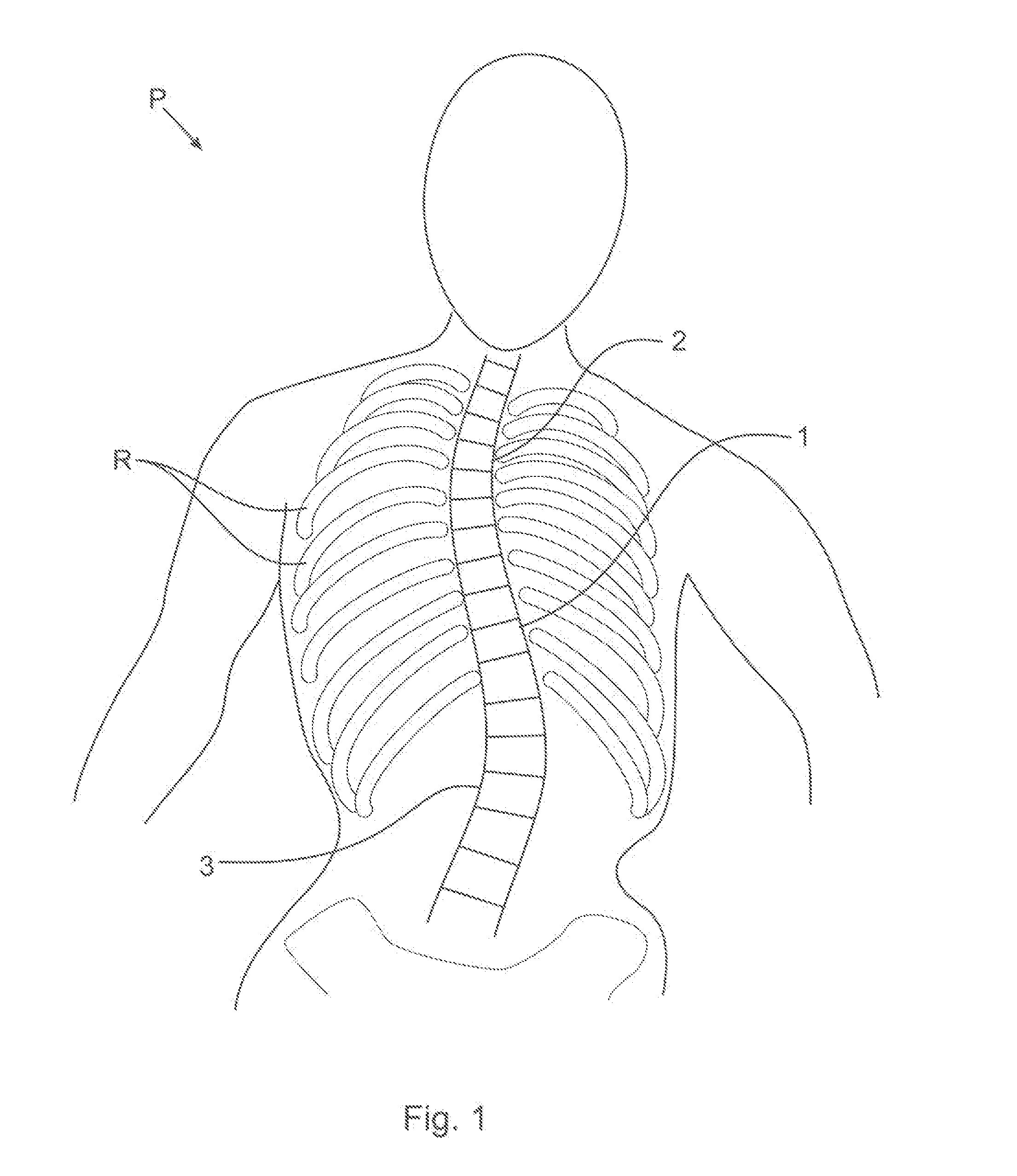 Percutaneous method for aligning a spine using deployable bone anchors