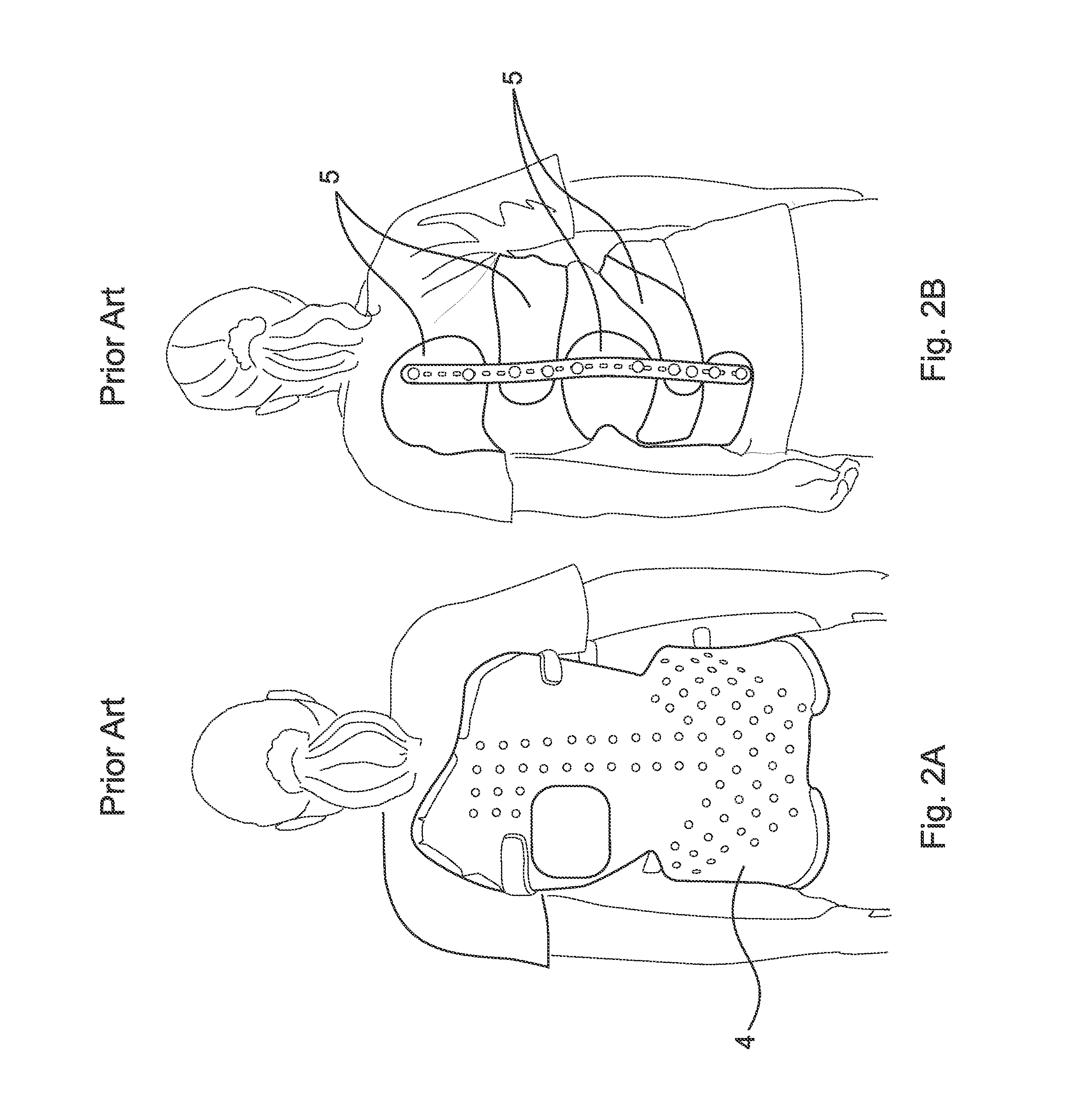 Percutaneous method for aligning a spine using deployable bone anchors