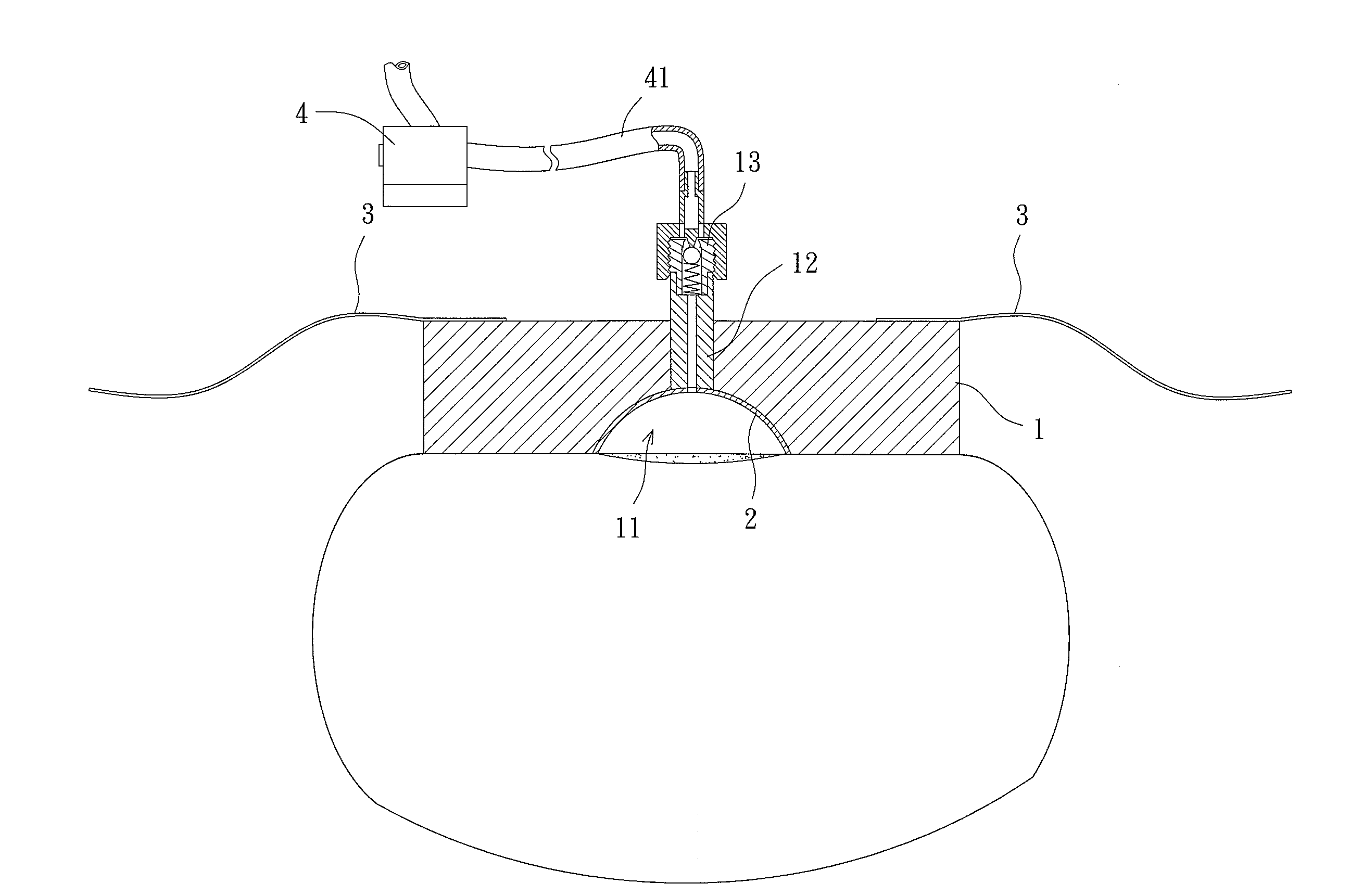 Negative Pressure Bandage