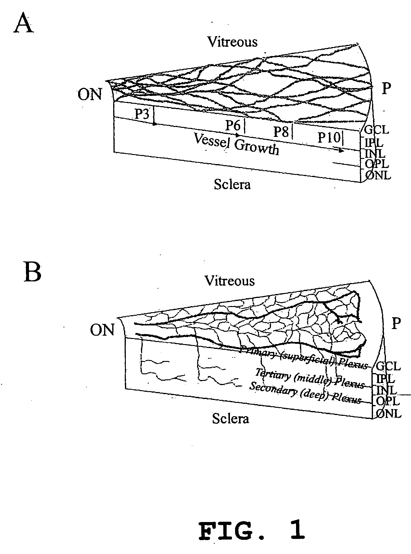 Transfected hematopoietic stem cells and methods of treatment of neovascular eye diseases therewith