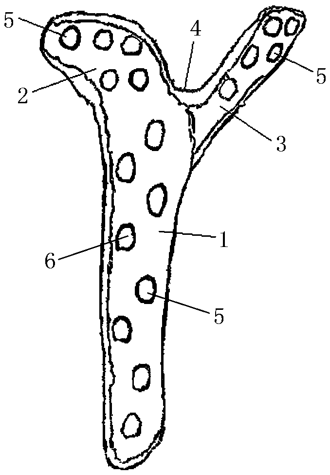 Tibial plateau locking bone fracture plate