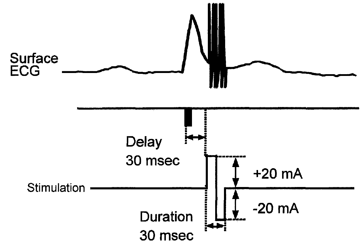 Methods and systems for heart failure treatments using ultrasound and leadless implantable devices