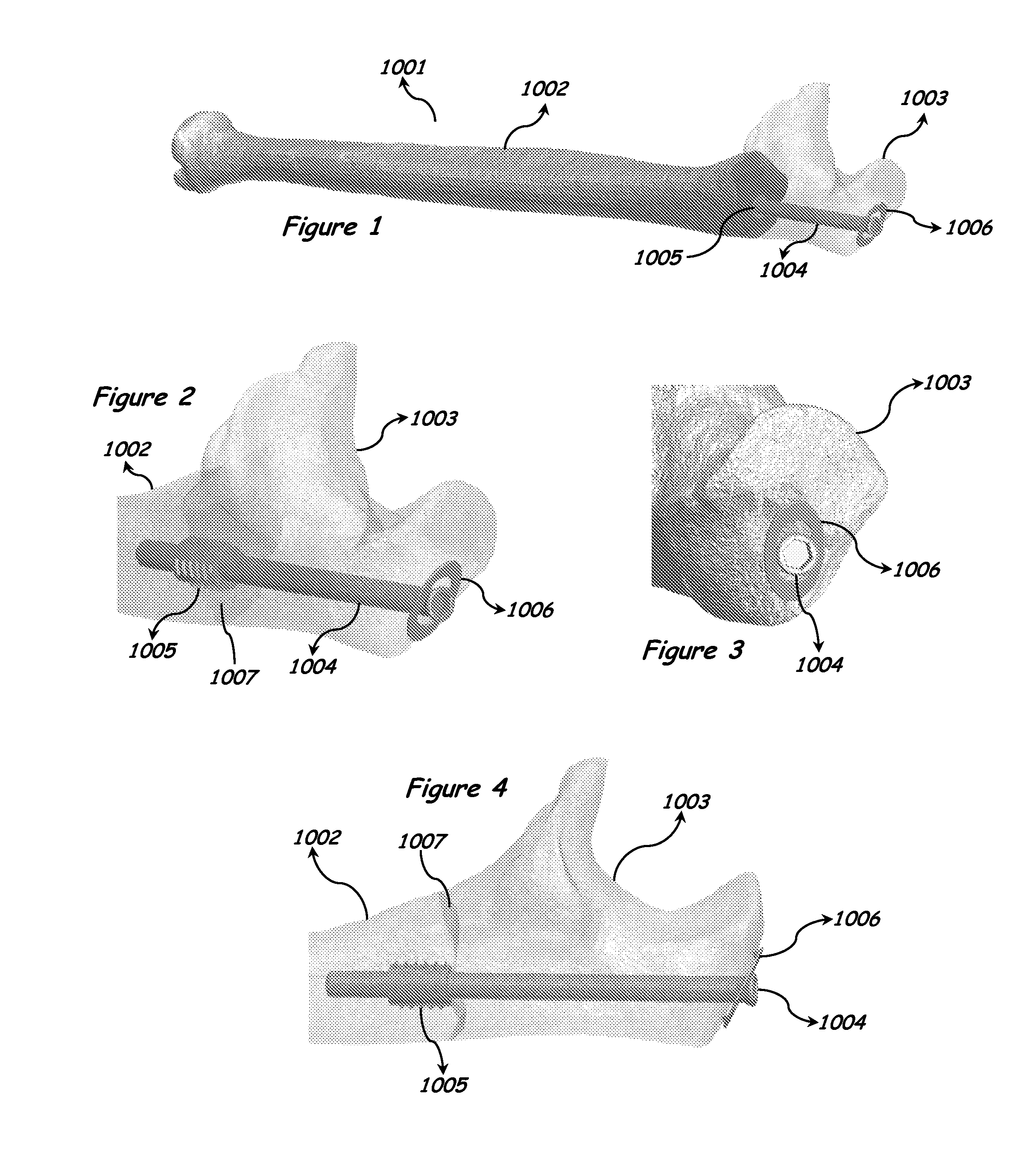 Intramedullary anchor-screw fracture fixation