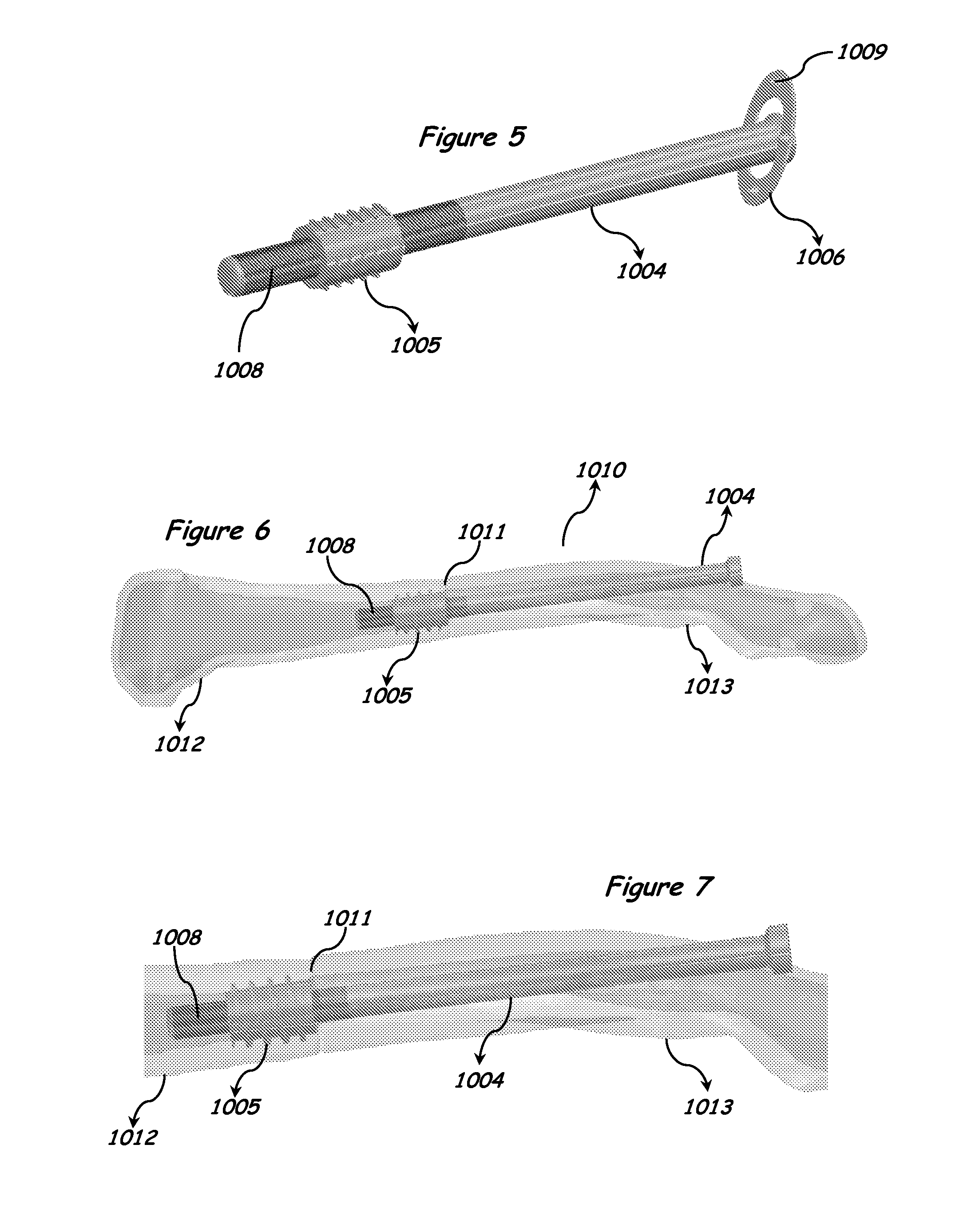 Intramedullary anchor-screw fracture fixation