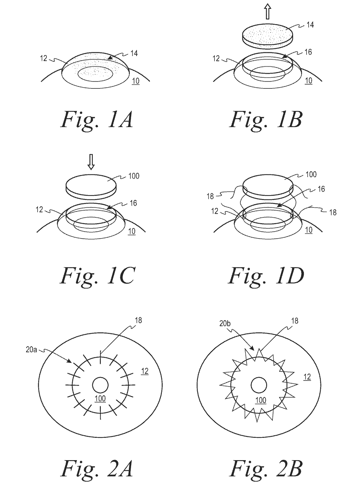 Systems and methods for corneal transplants