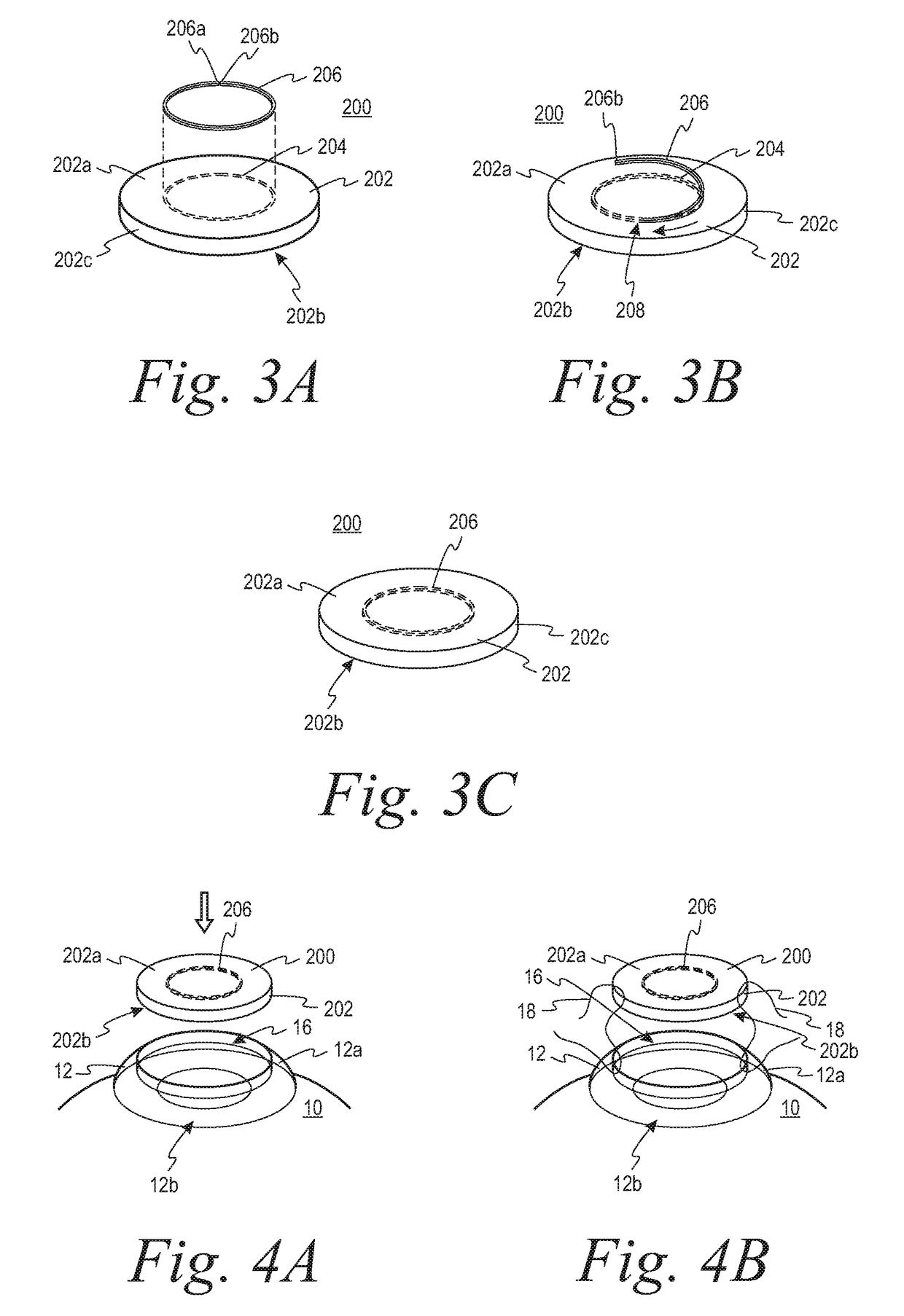 Systems and methods for corneal transplants