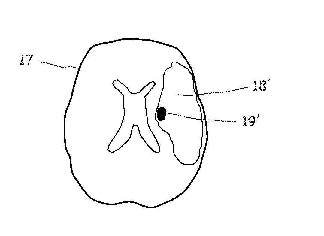 Method for segmenting and predicting tissue regions in patients with acute cerebral ischemia