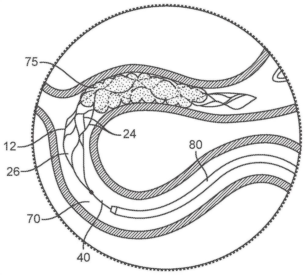 Thrombectomy device