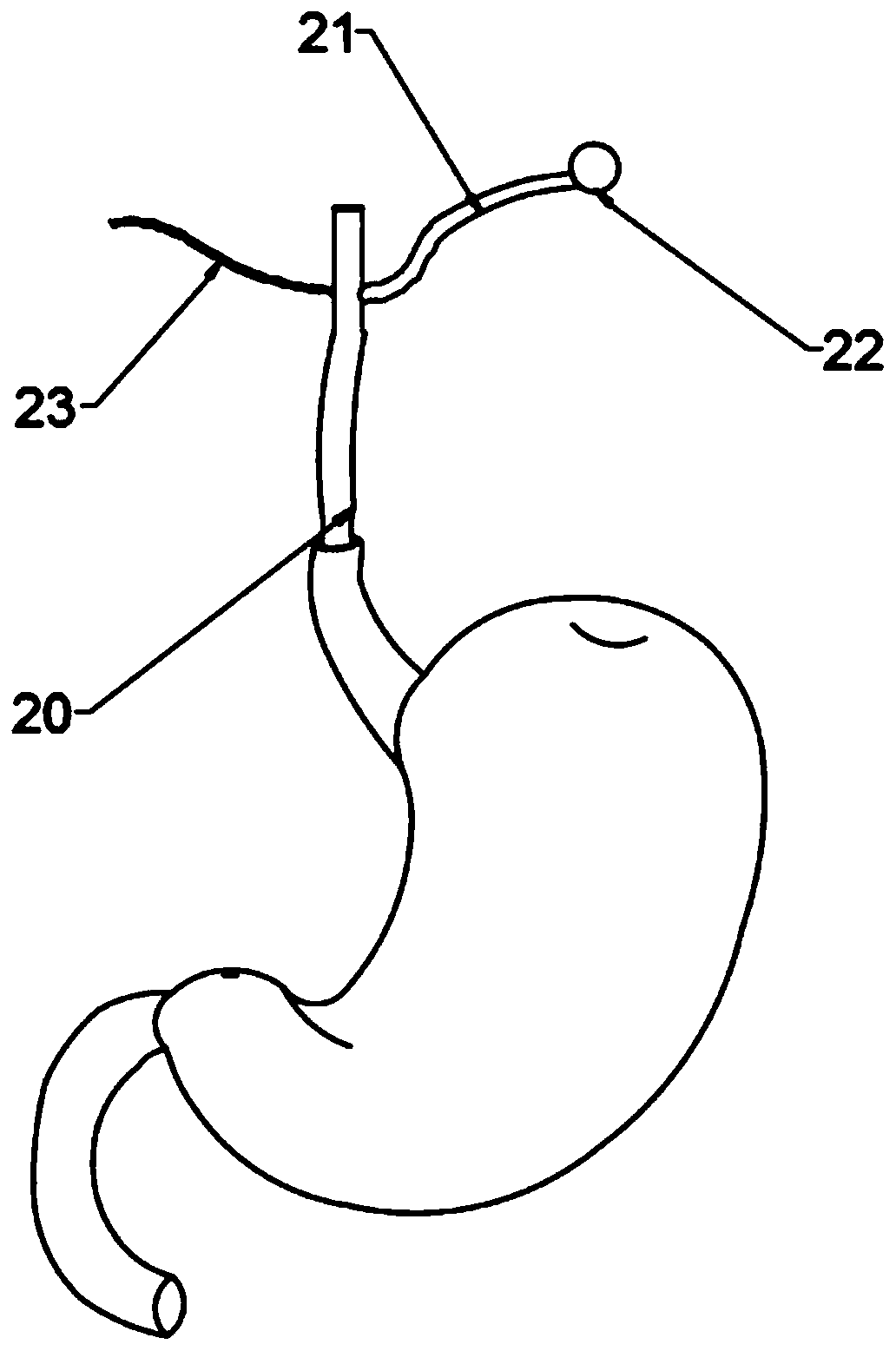 Individualized 3D precision gastric mucosa thermal injury stomach volume reduction gasbag device