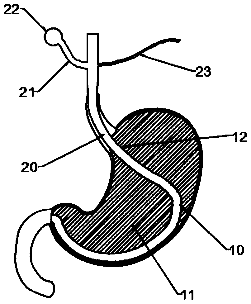 Individualized 3D precision gastric mucosa thermal injury stomach volume reduction gasbag device