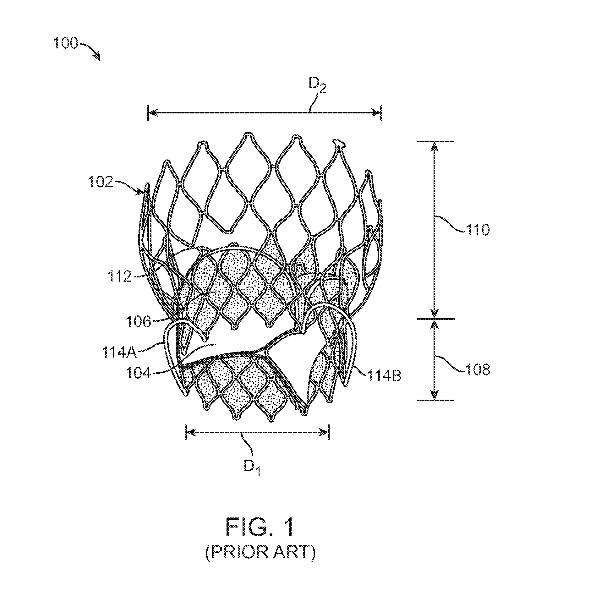 Transcatheter Valve Prosthesis and a Concurrently Delivered Sealing Component