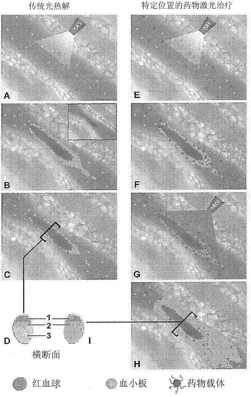 Drug delivery system for the treatment of vascular diseases