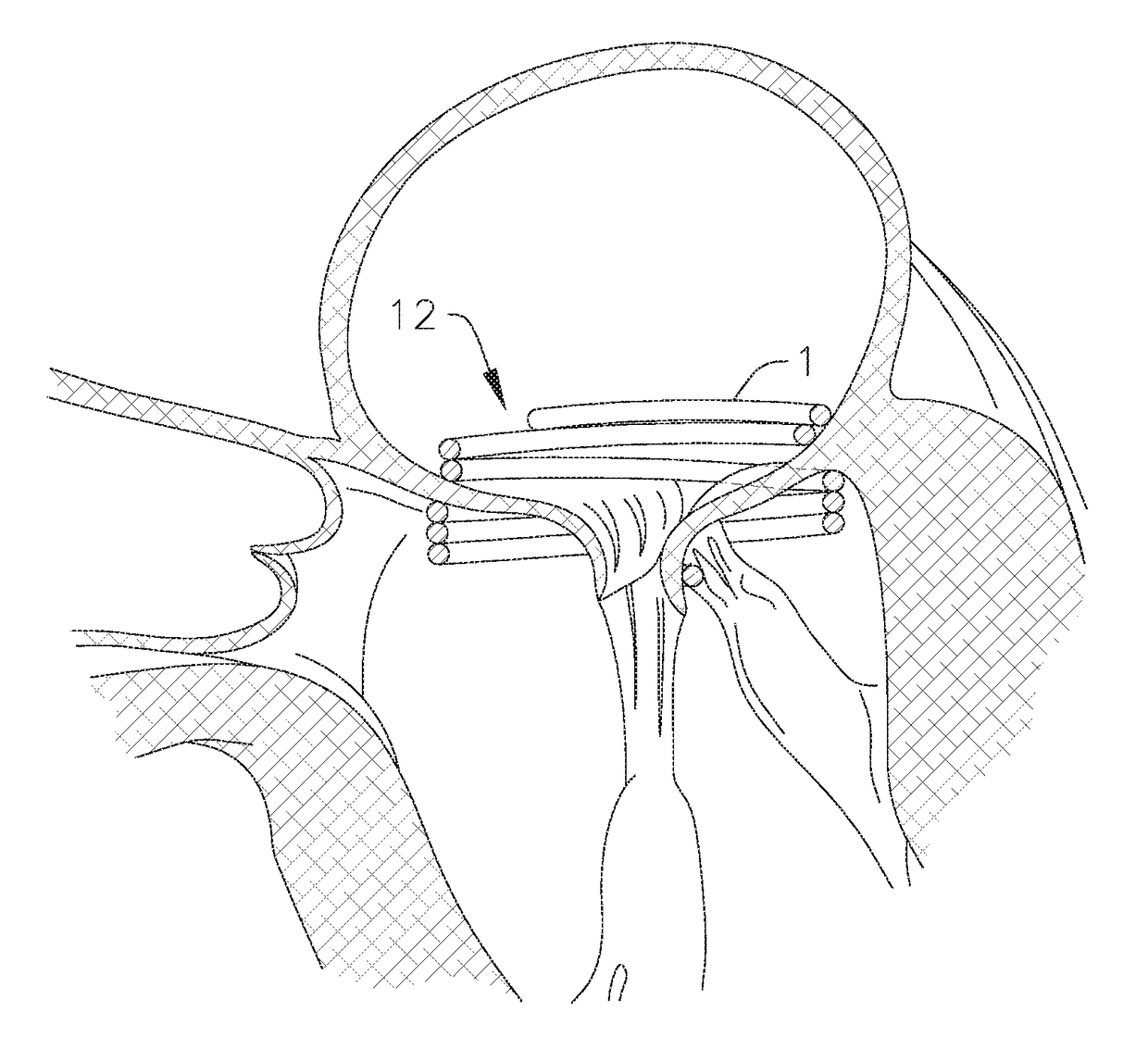 Heart valve docking system