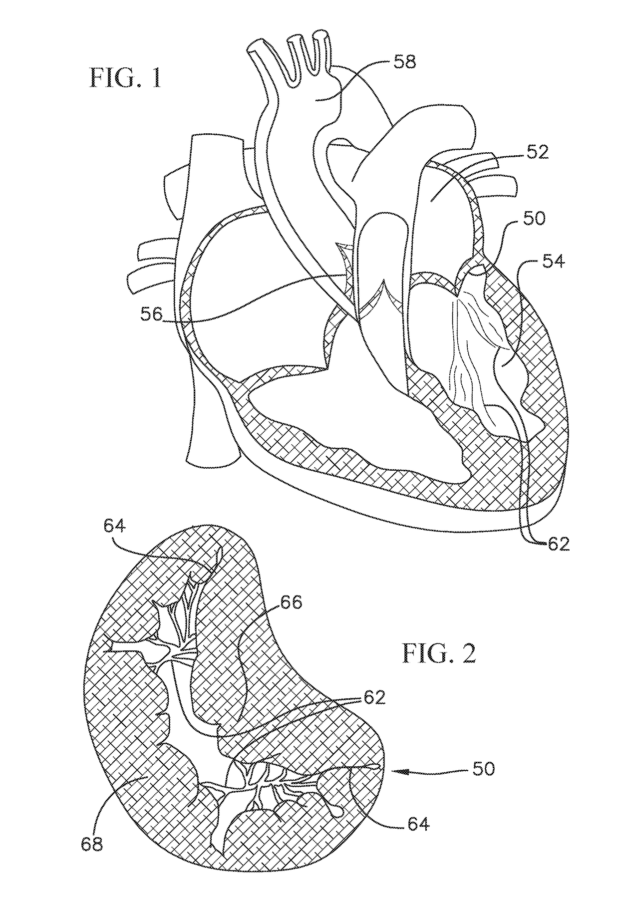 Heart valve docking system