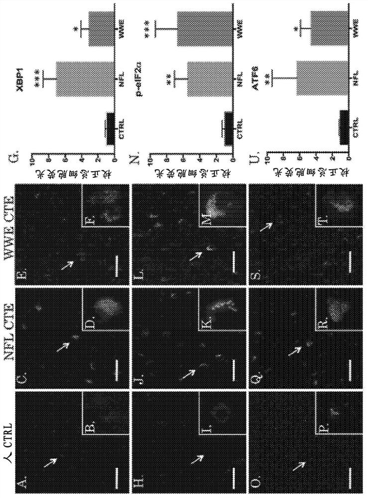 Treatment of chronic traumatic encephalopathy