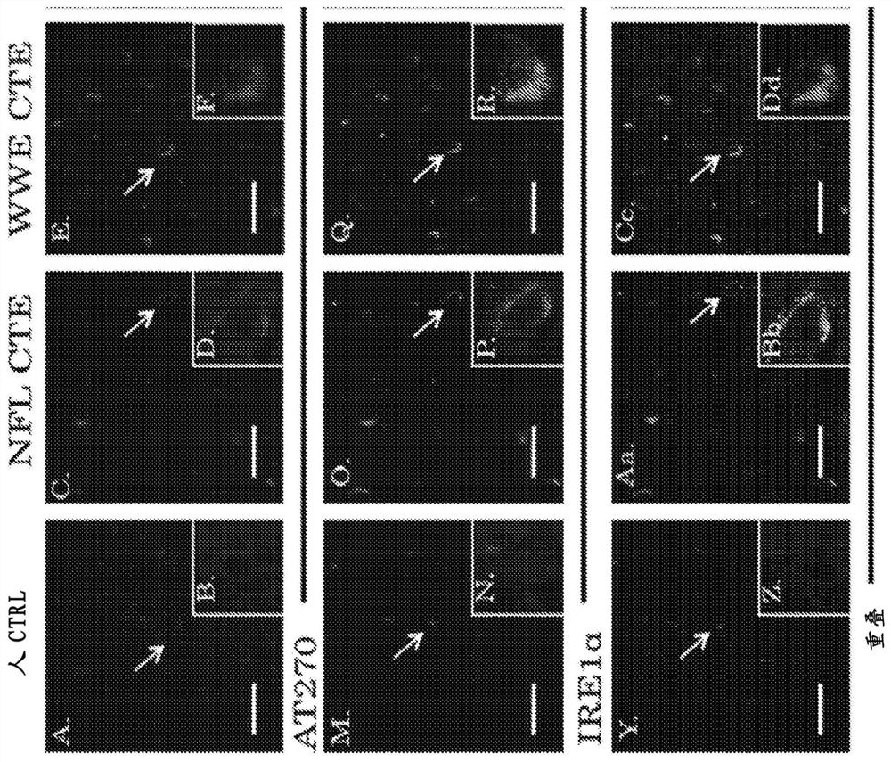 Treatment of chronic traumatic encephalopathy