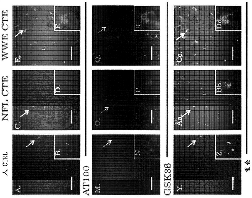 Treatment of chronic traumatic encephalopathy