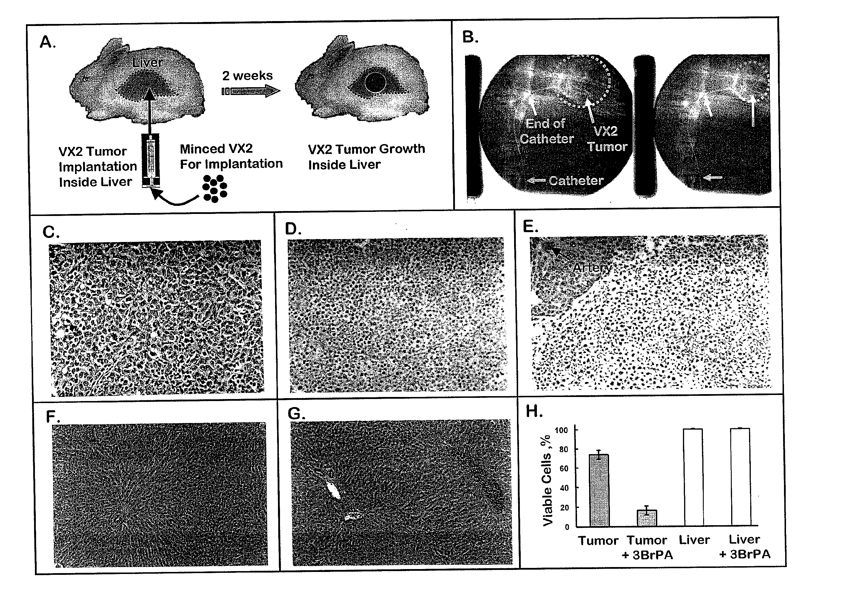 Therapeutics for Cancer Using 3-Bromopyruvate and Other Selective Inhibitors of ATP Production