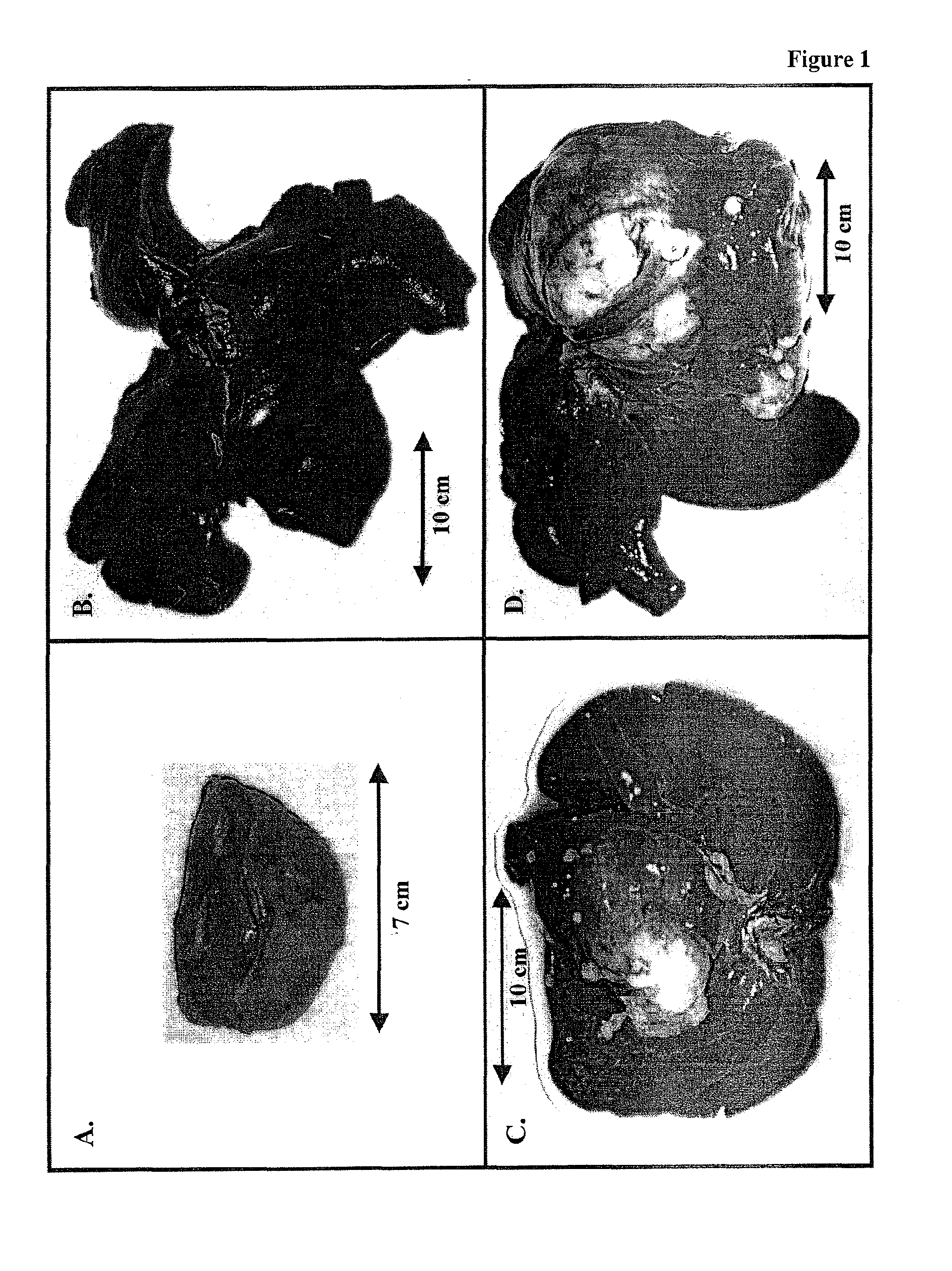 Therapeutics for Cancer Using 3-Bromopyruvate and Other Selective Inhibitors of ATP Production