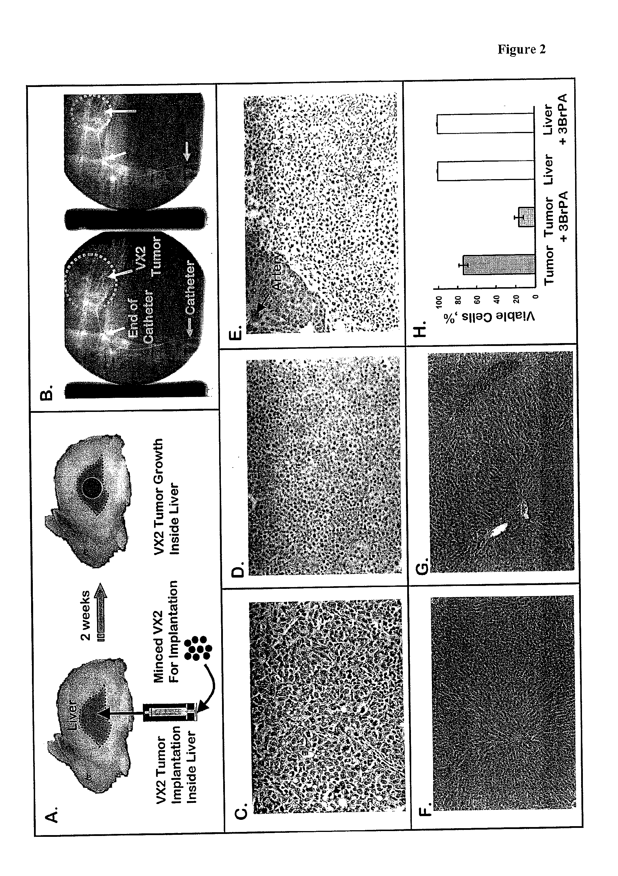 Therapeutics for Cancer Using 3-Bromopyruvate and Other Selective Inhibitors of ATP Production