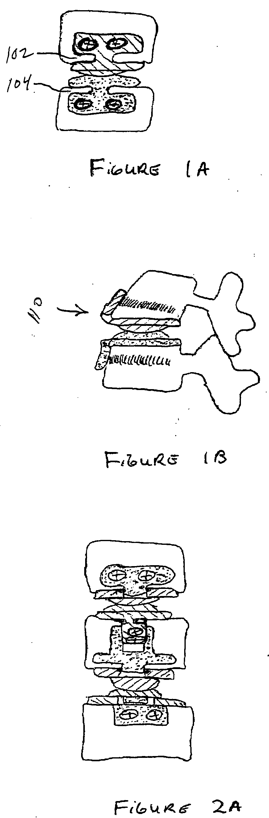 Artificial disc replacement (ADR) fixation methods and apparatus