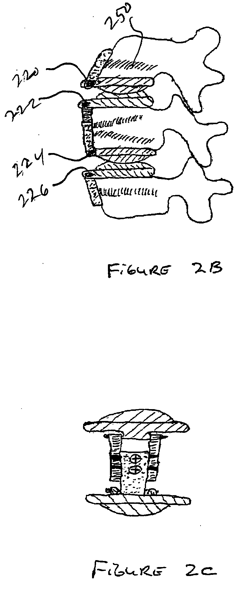 Artificial disc replacement (ADR) fixation methods and apparatus