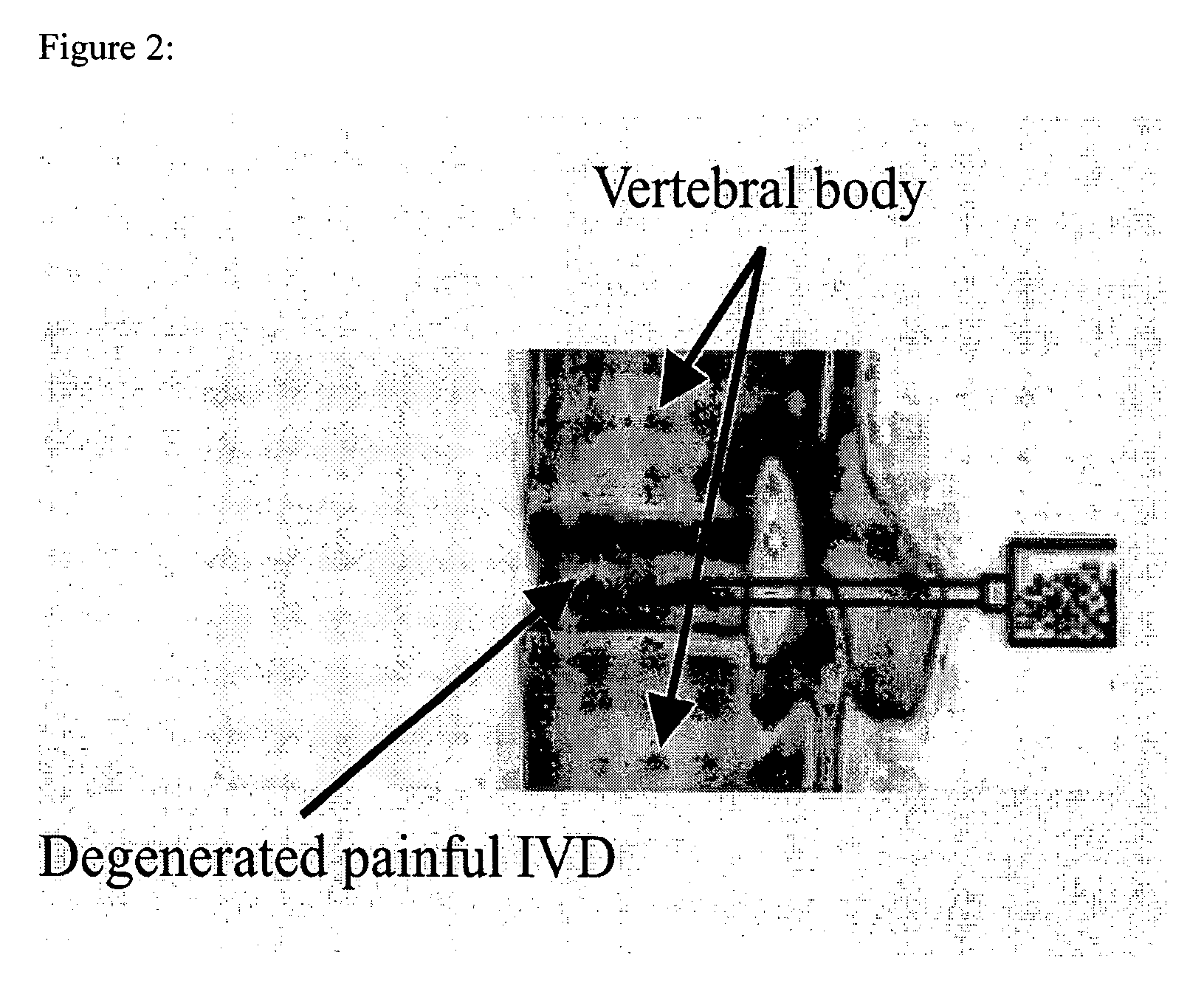 In situ controlled release drug delivery system