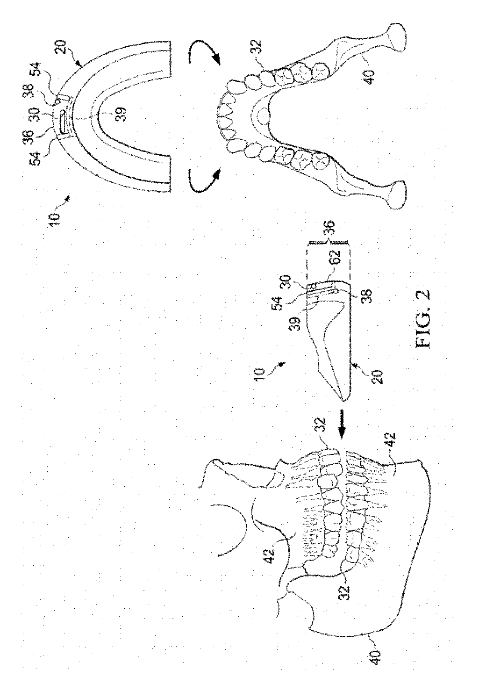 Vibrating orthodontic remodelling device