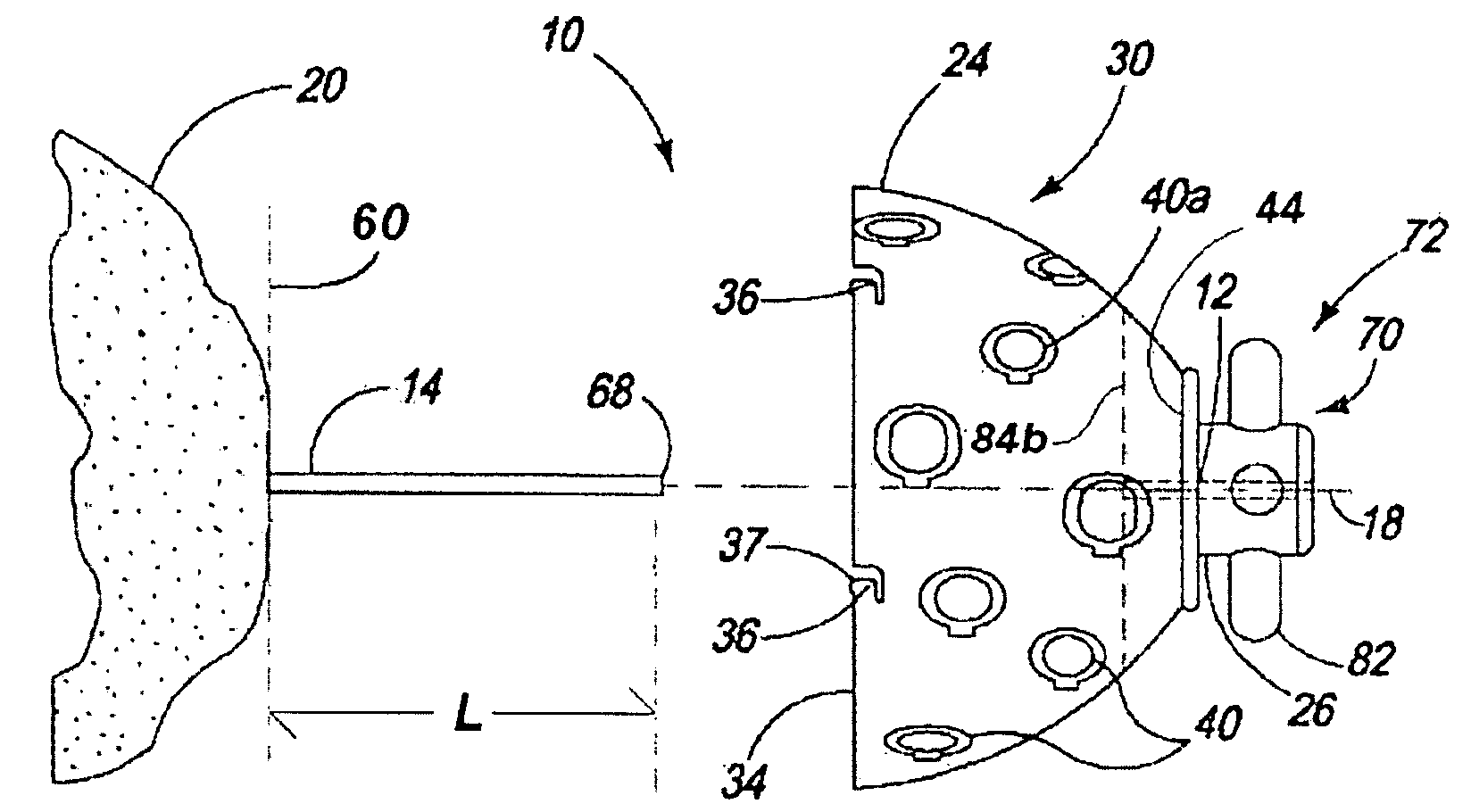 Resurfacing reamer with cutting struts