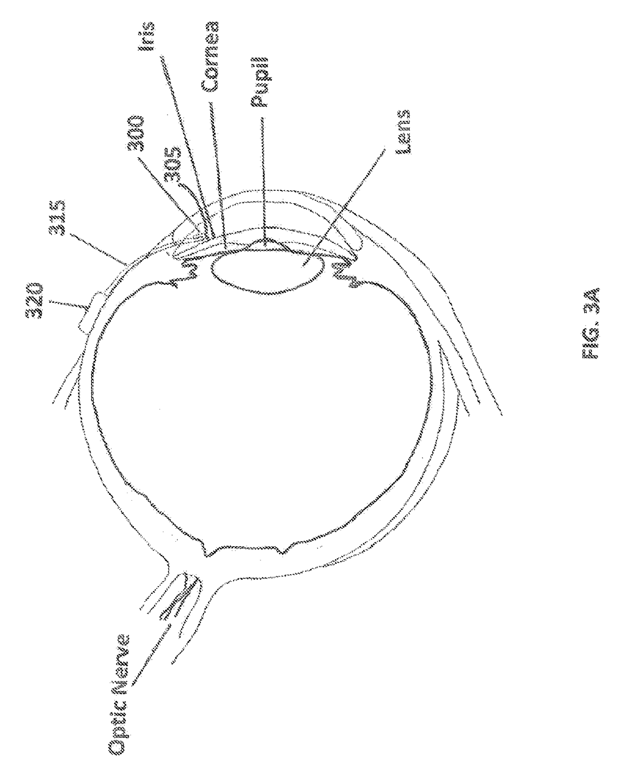 Ocular filtration devices, systems and methods