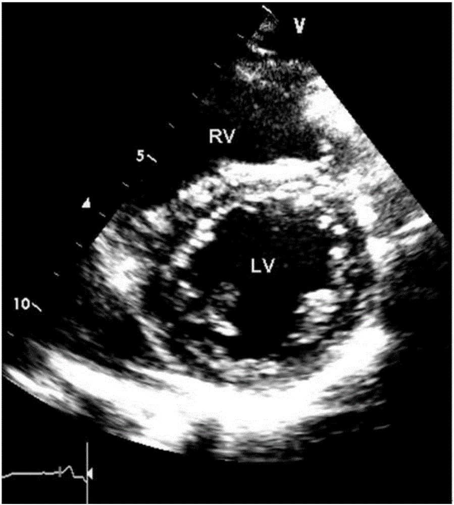 Method for non-invasive measurement of right ventricular pressure and pulmonary artery pressure method