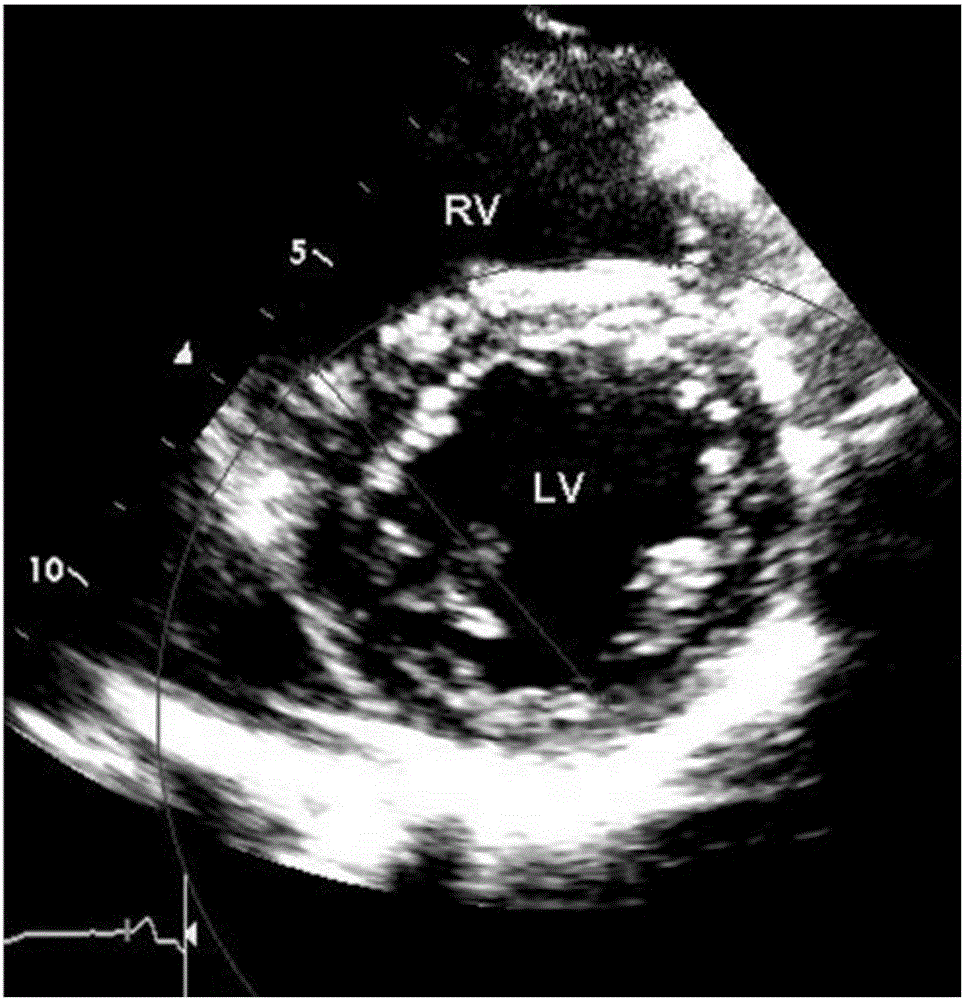 Method for non-invasive measurement of right ventricular pressure and pulmonary artery pressure method