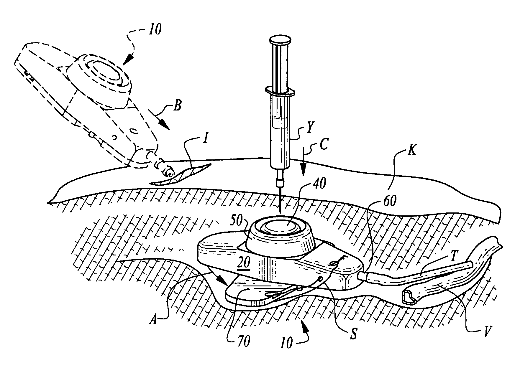 Stabilized implantable vascular access port