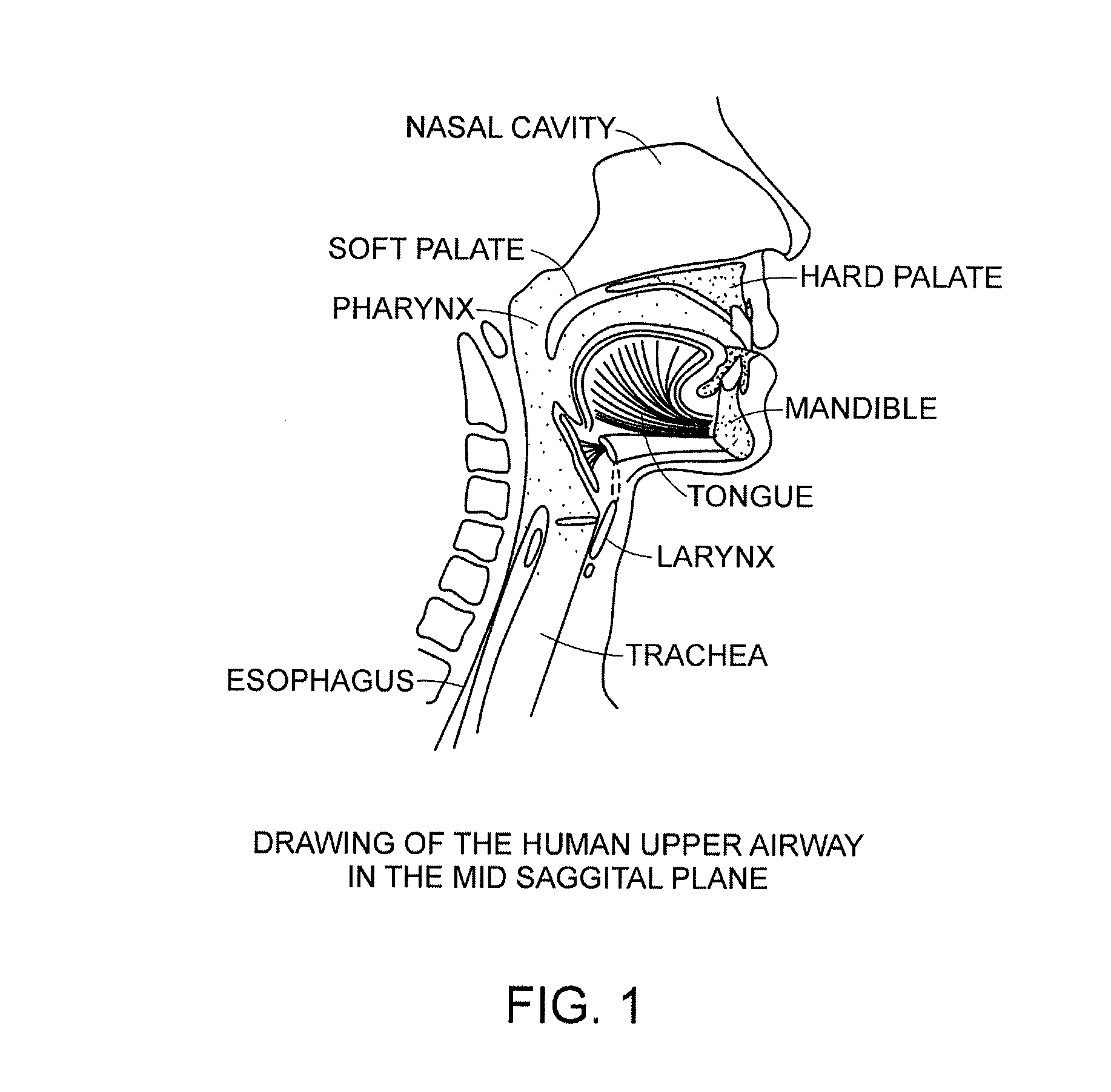 Methods and devices for treating sleep apnea and snoring