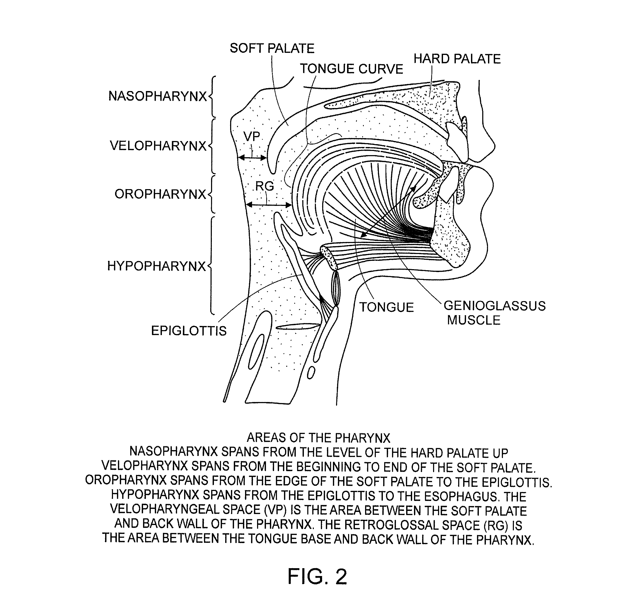 Methods and devices for treating sleep apnea and snoring