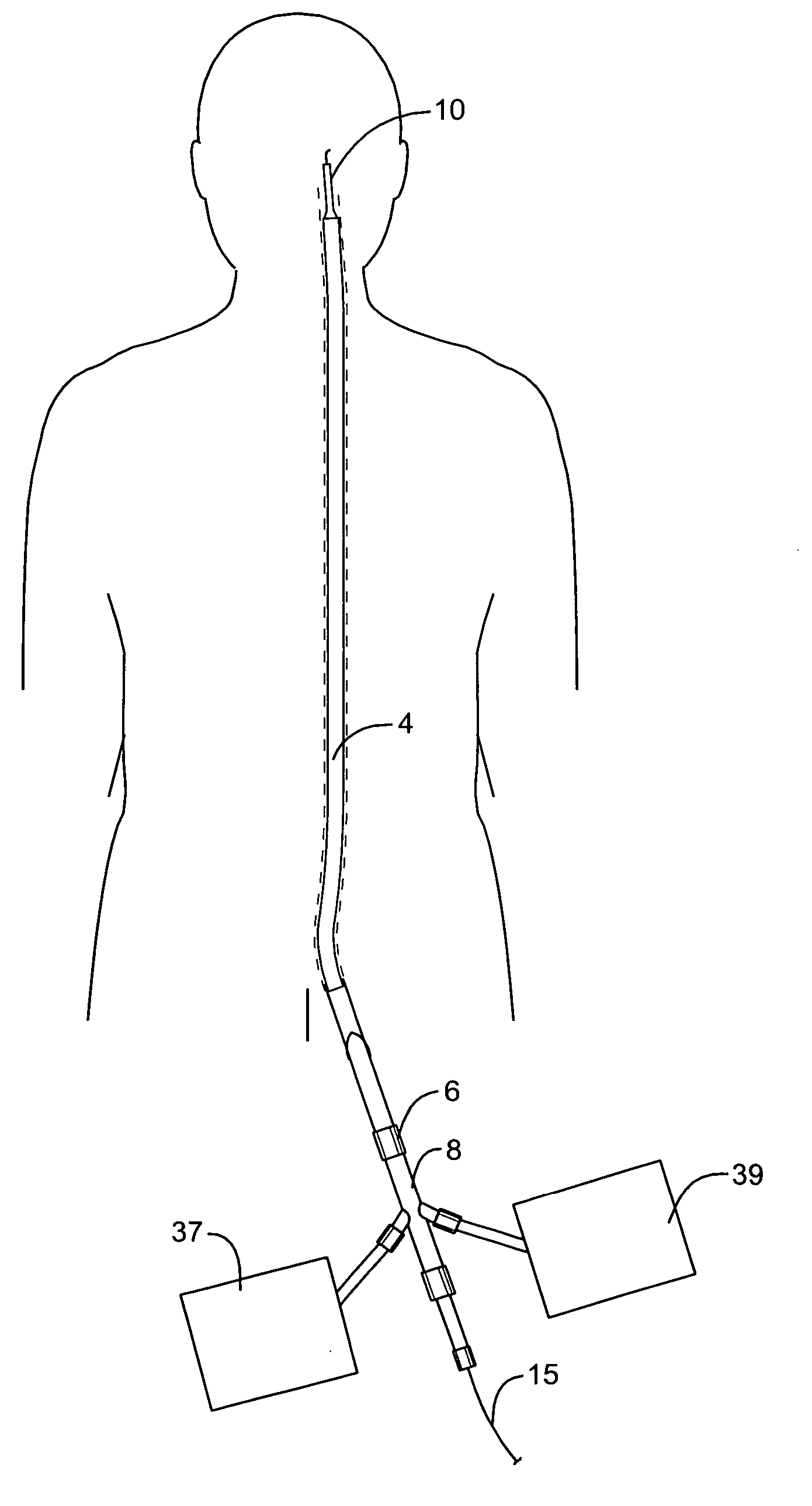 Methods and devices for protecting passageway in a body when advancing devices through the passageway