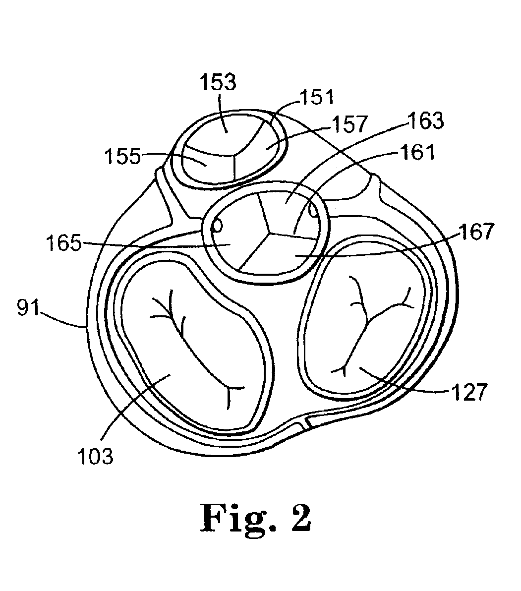 Valve treatment catheter and methods