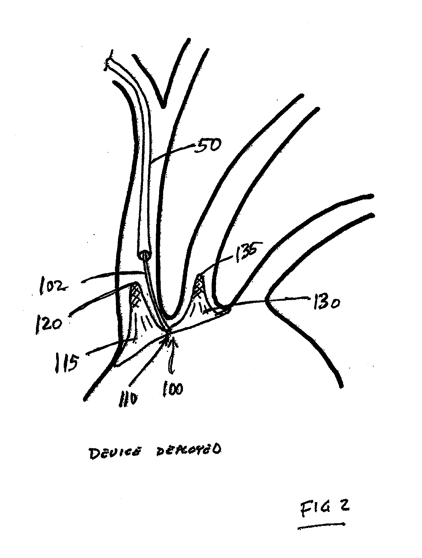 Dual endovascular filter and methods of use