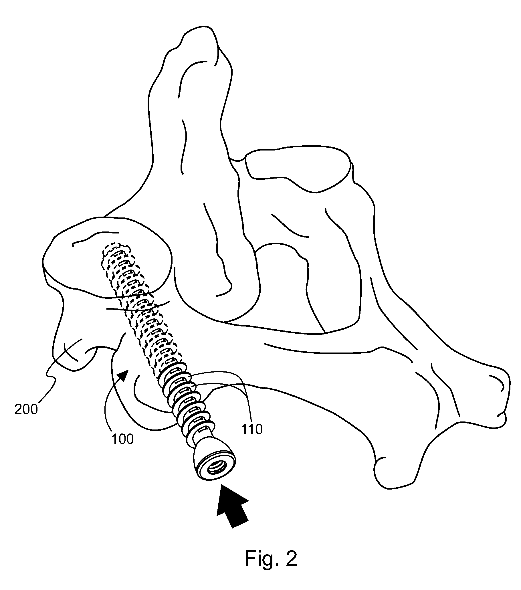 Method and device for delivering medicine to bone