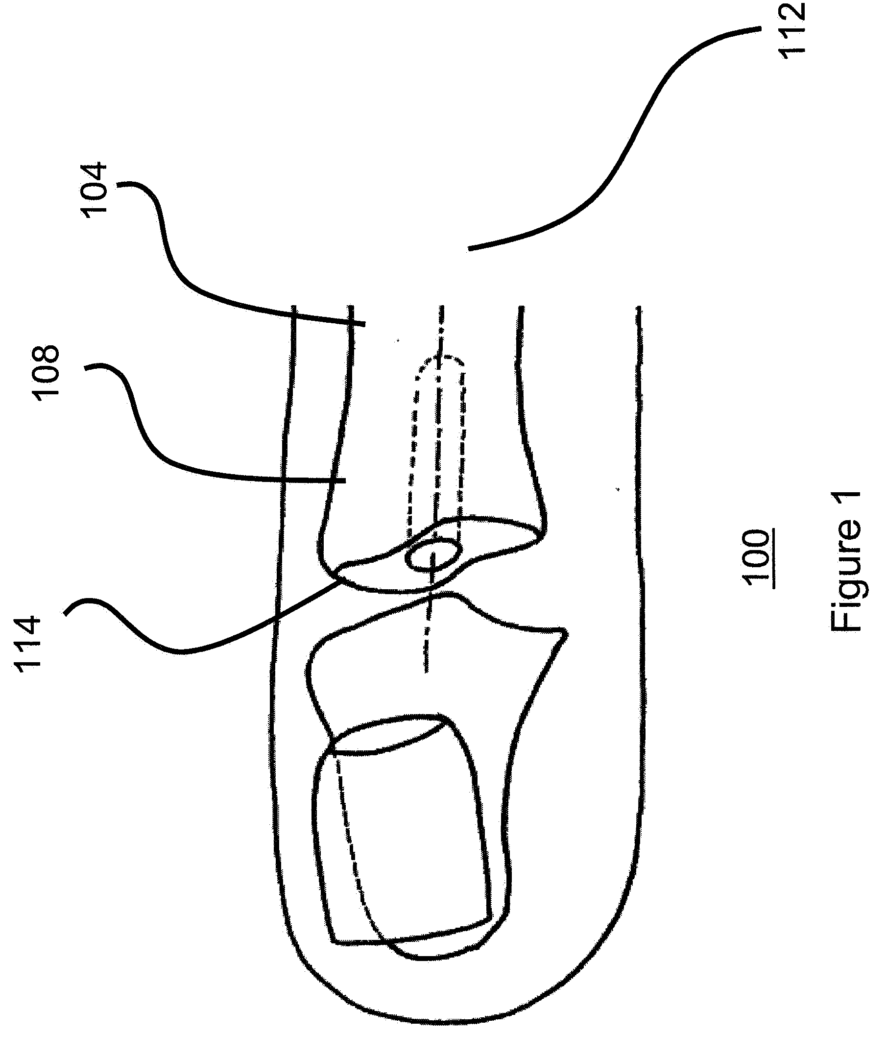 Small joint hemiarthroplasty