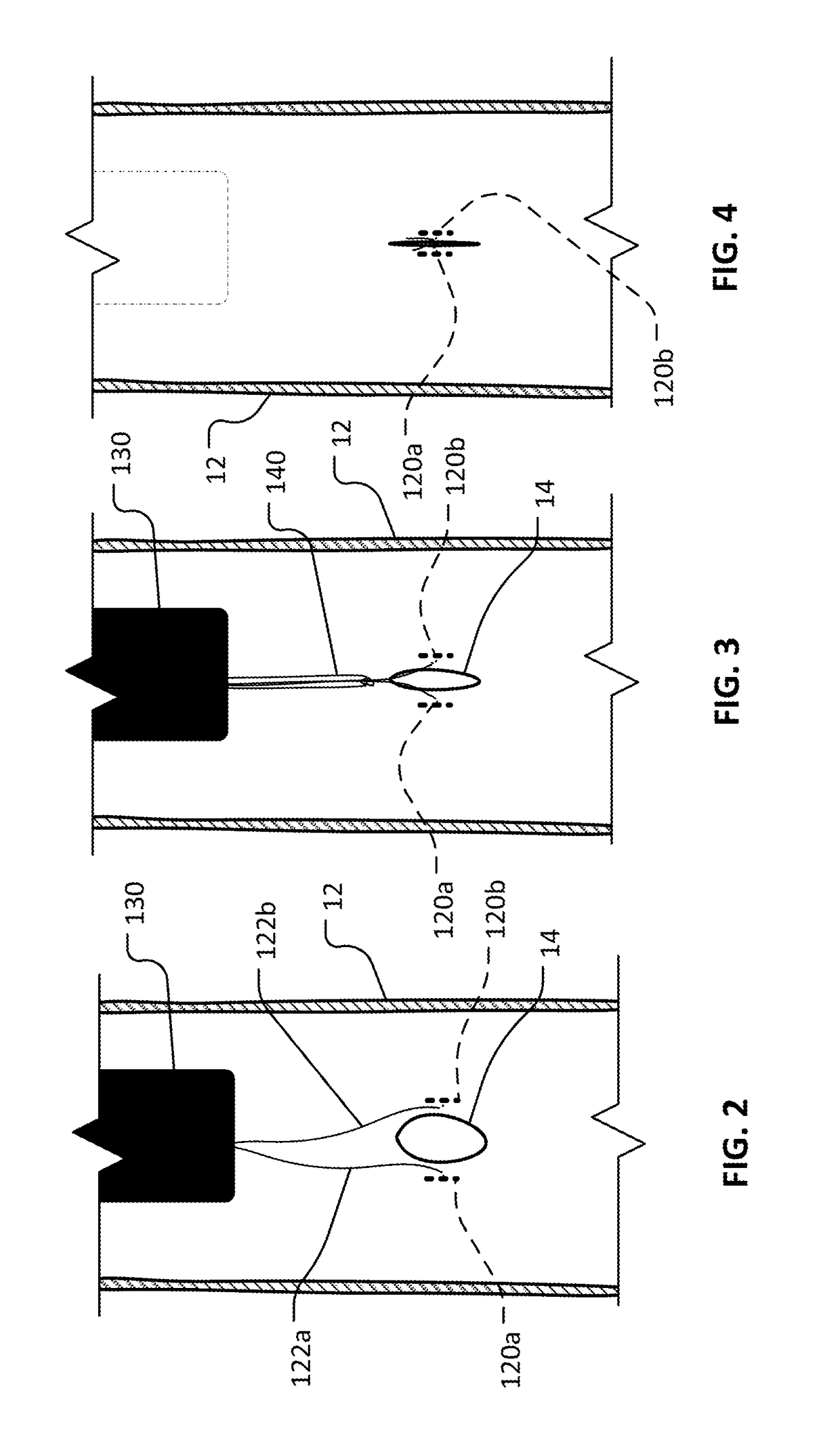 Endoluminal anastomosis and tissue closure devices