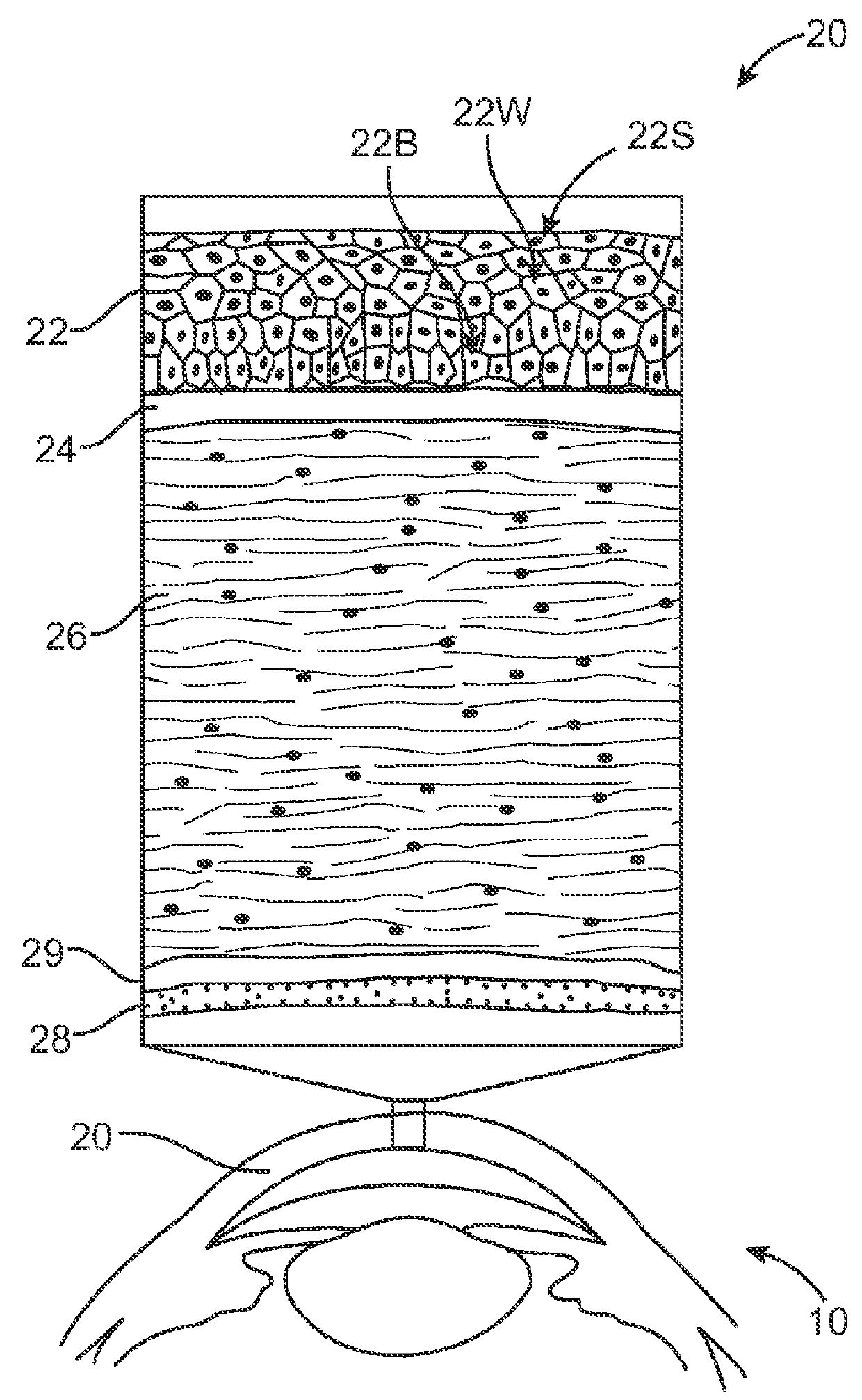 Corneal Denervation for Treatment of Ocular Pain