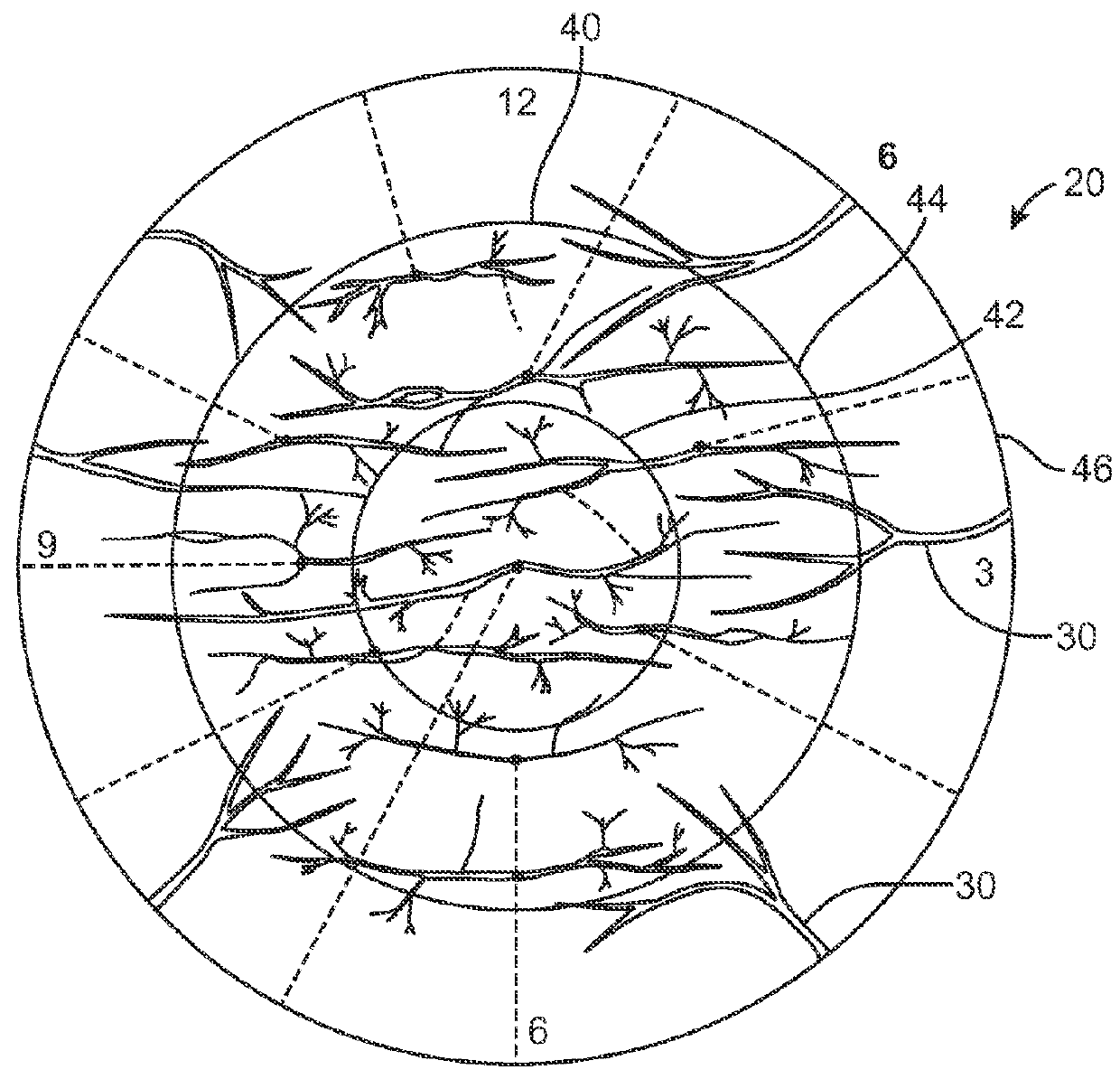 Corneal Denervation for Treatment of Ocular Pain