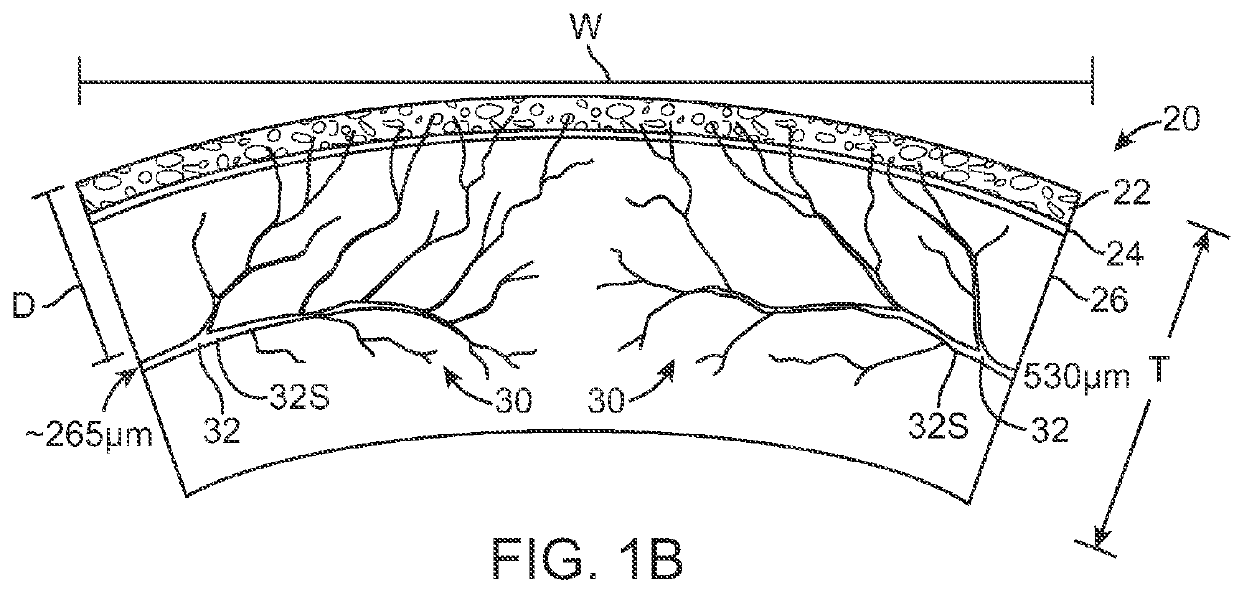 Corneal Denervation for Treatment of Ocular Pain